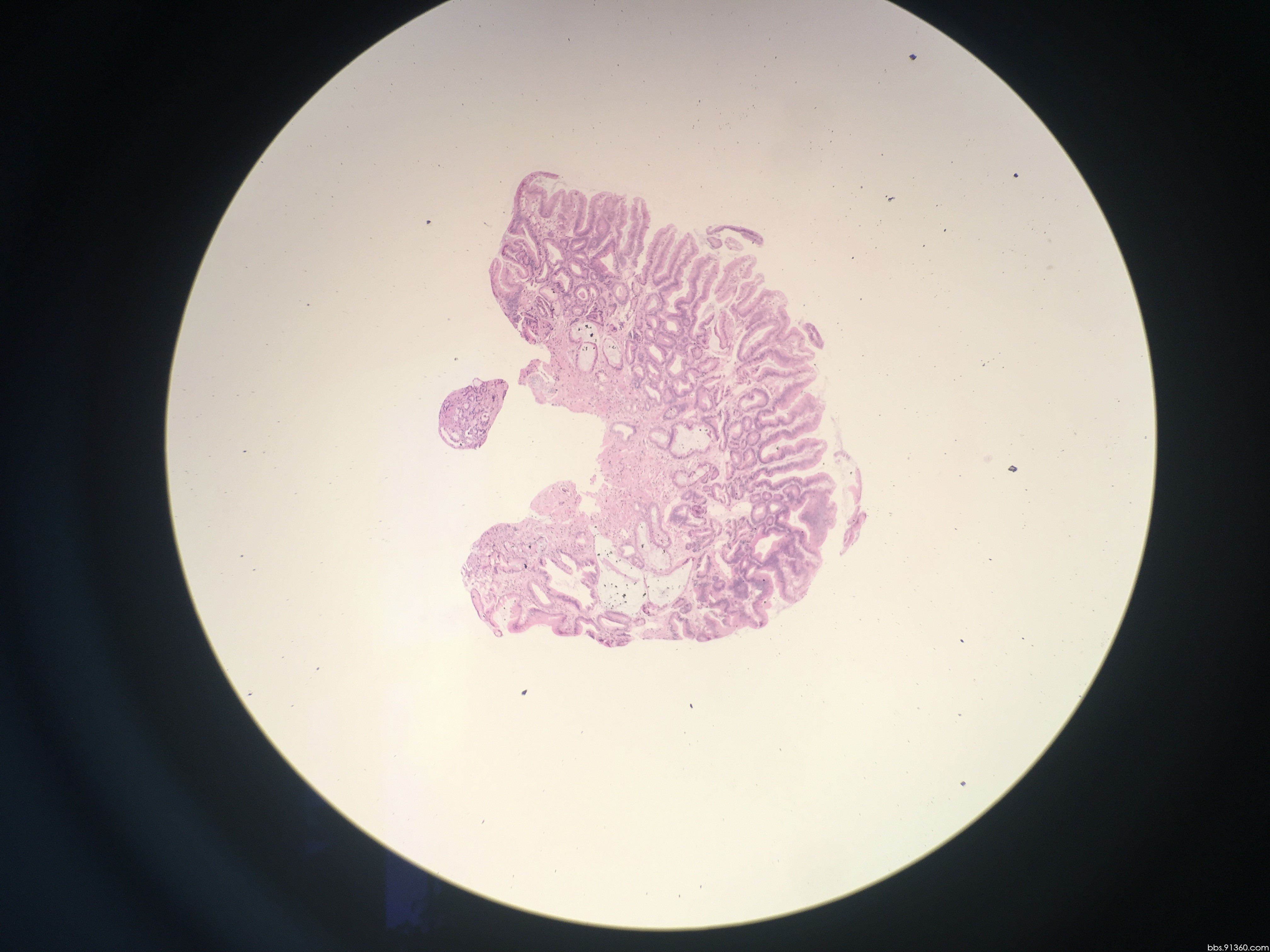 胃窦管状腺瘤,局灶呈高级别上皮内瘤变讨论2017.06.