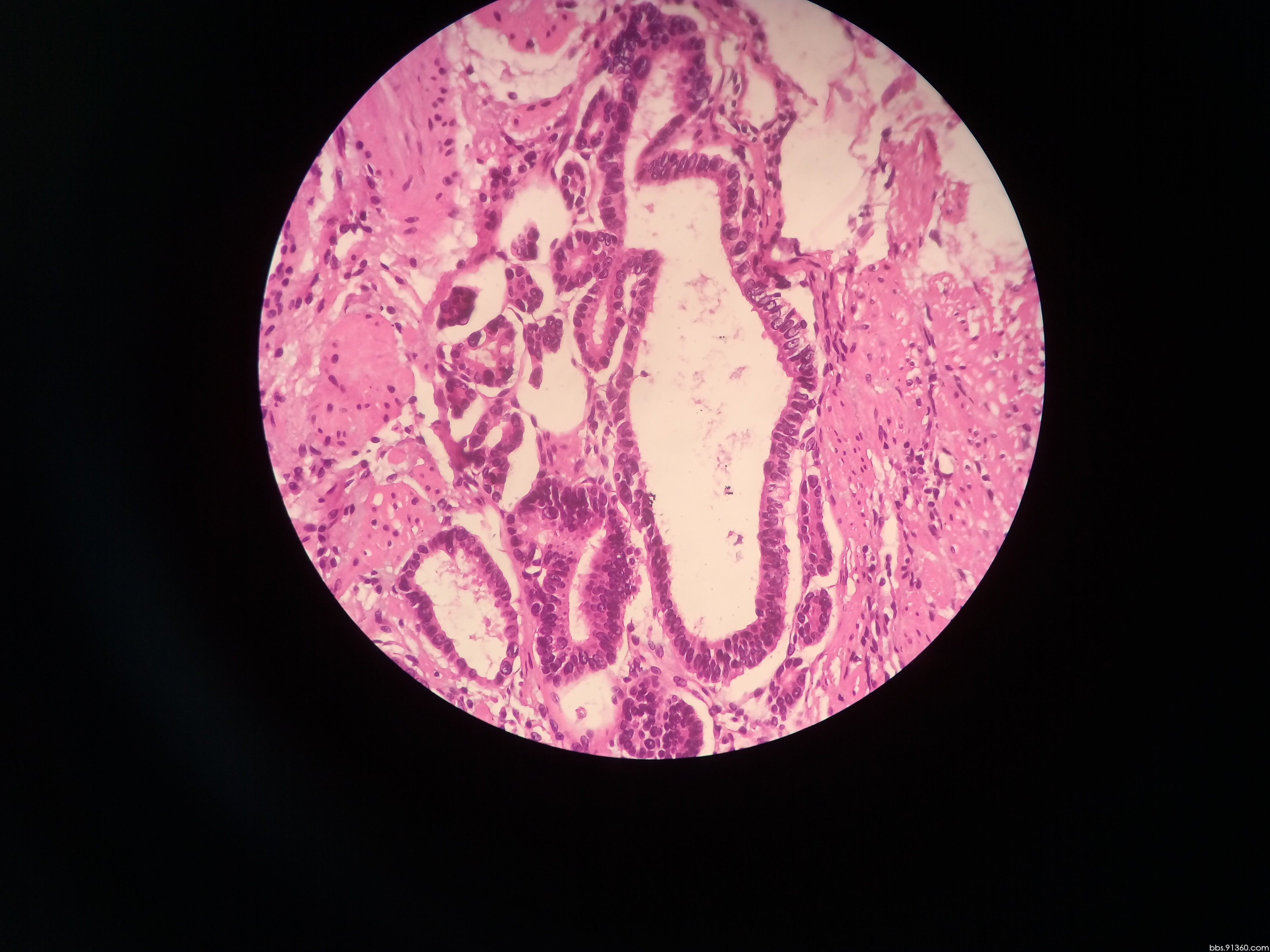 贲门高分化管状腺癌讨论2017.06.28【91360消化病理沙龙病例讨论290】