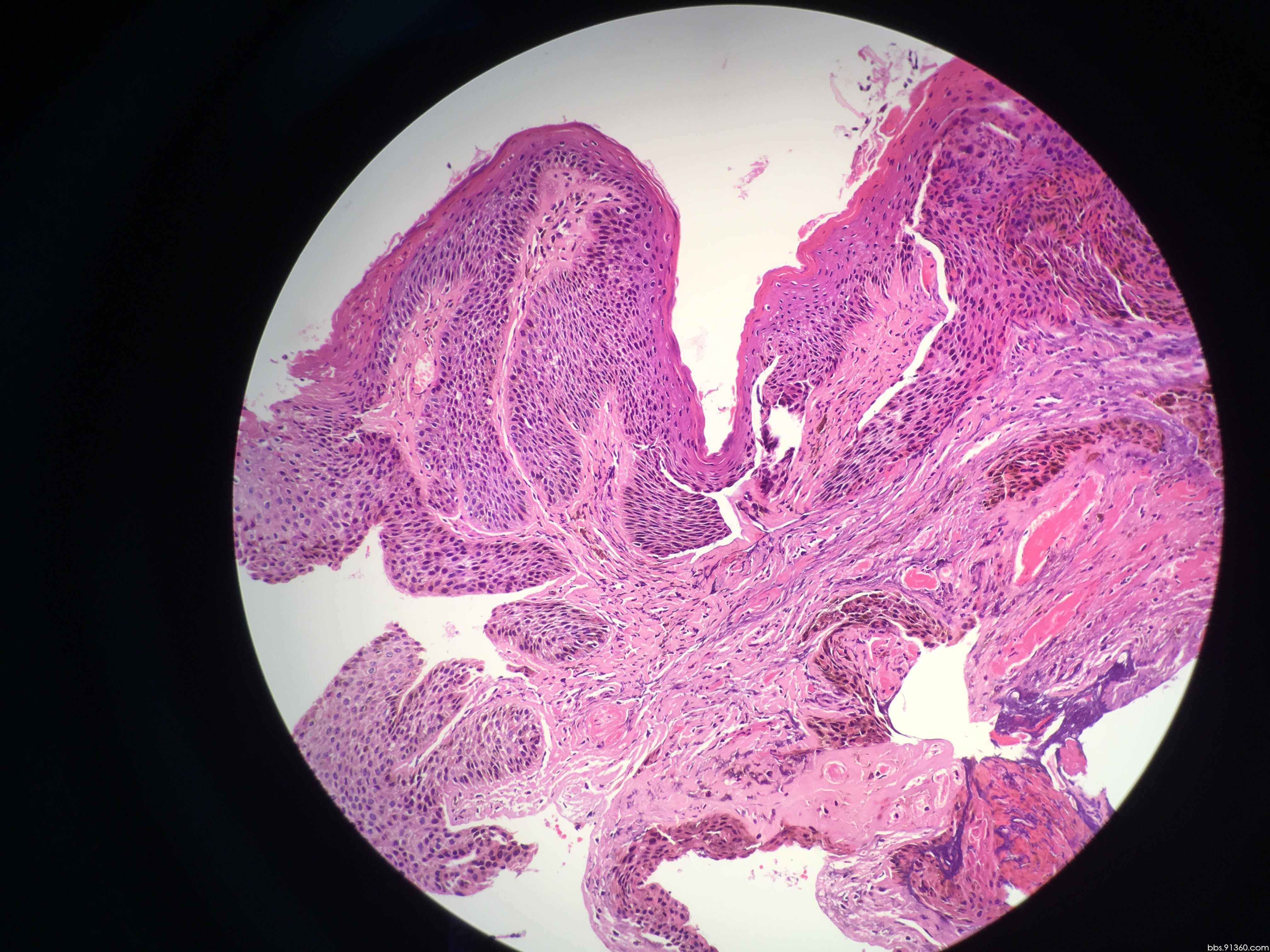 0628【91360皮肤沙龙病例160】 - 皮肤病理 - 91360病理论坛