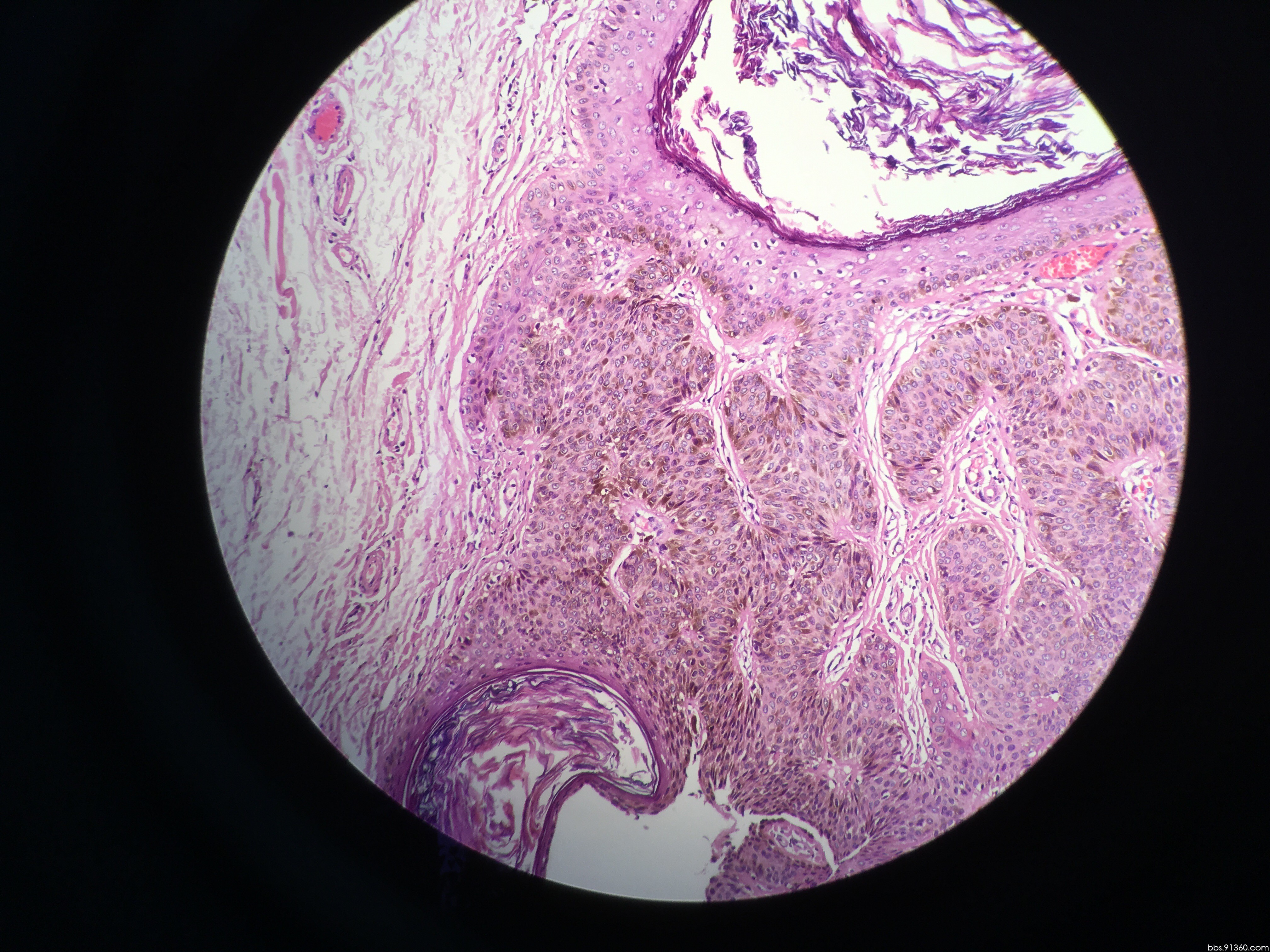 0628【91360皮肤沙龙病例160】 - 皮肤病理 - 91360病理论坛