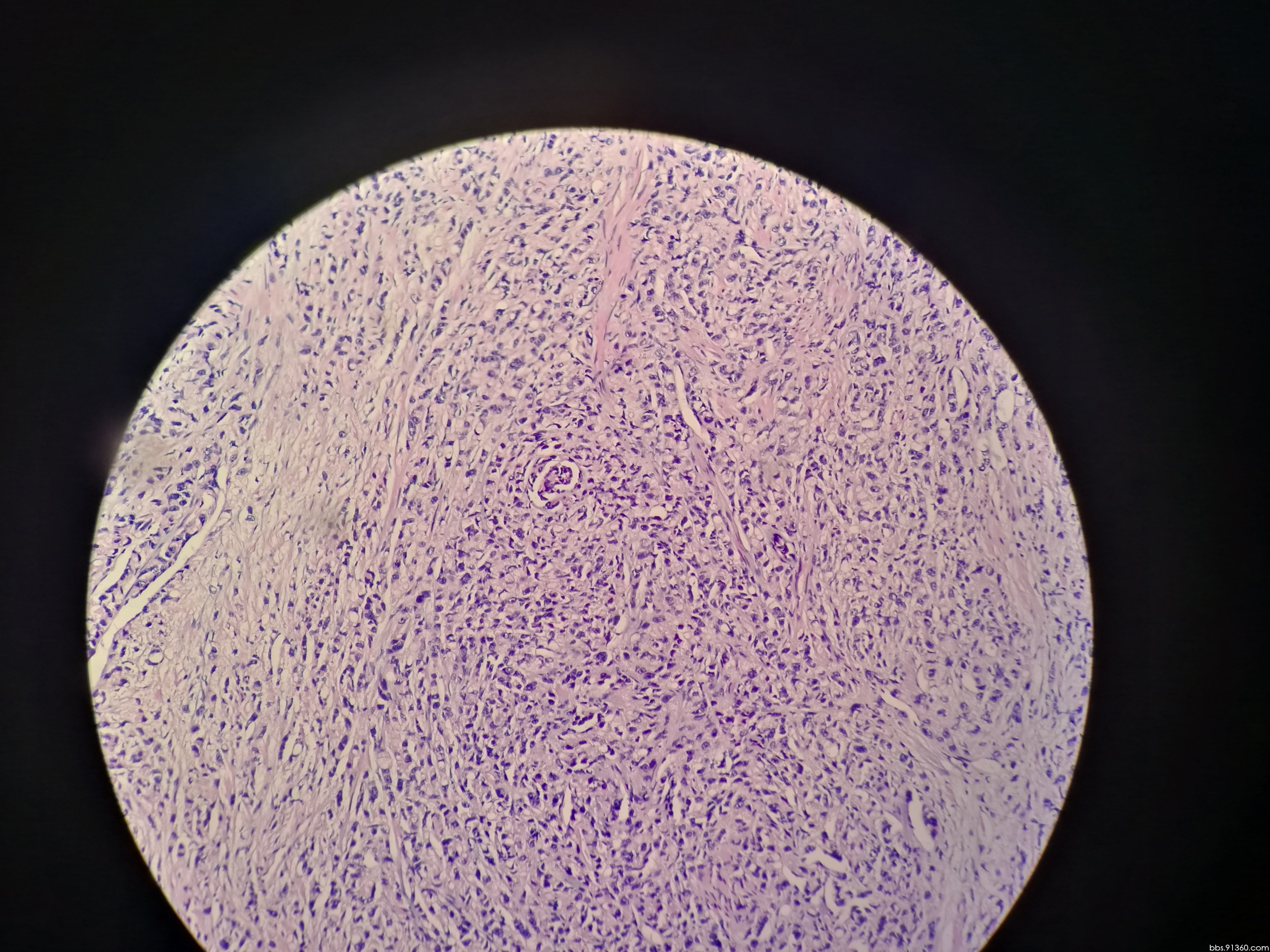 前列腺癌? - 泌尿和男性生殖系统 - 91360病理论坛