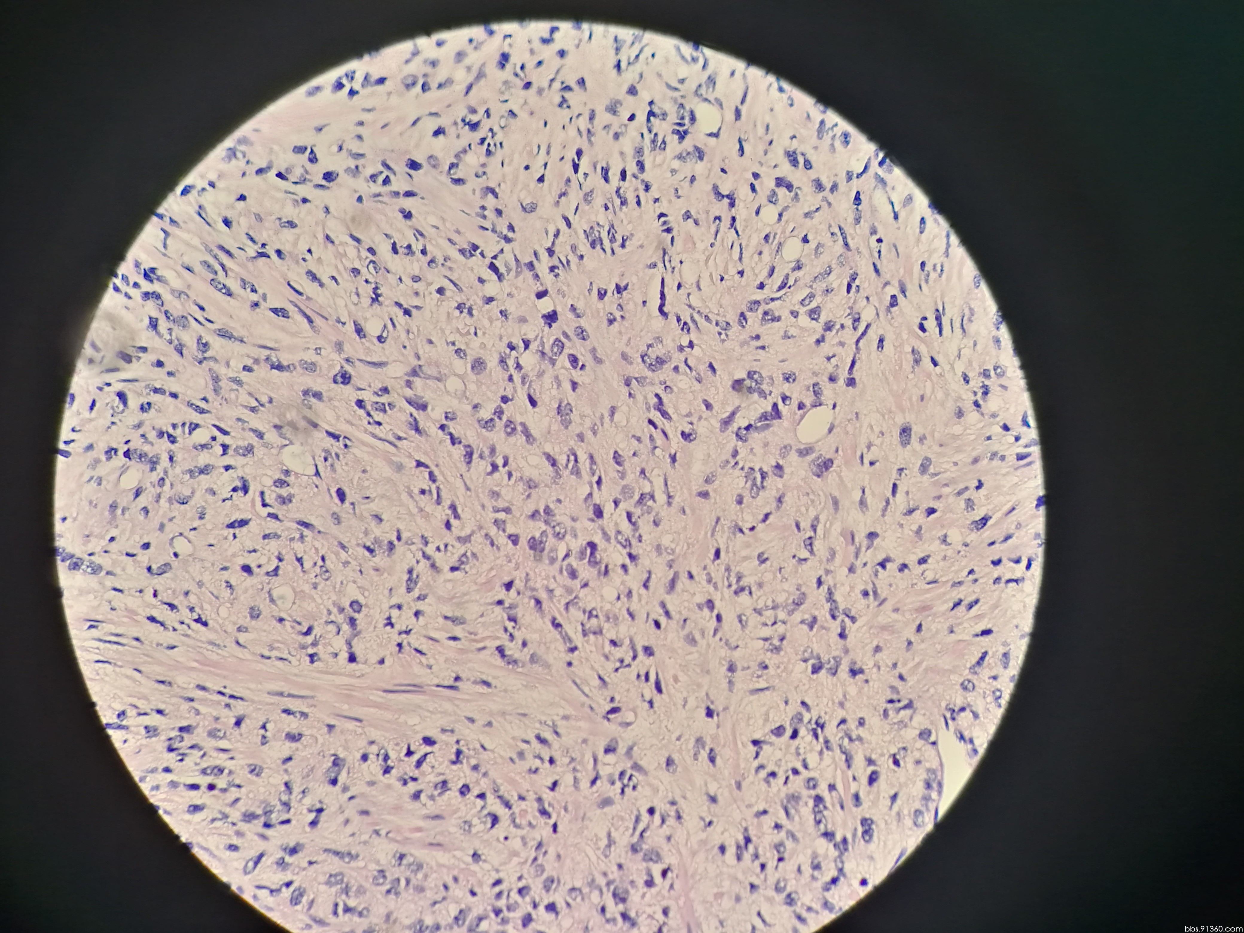 前列腺癌? - 泌尿和男性生殖系统 - 91360病理论坛