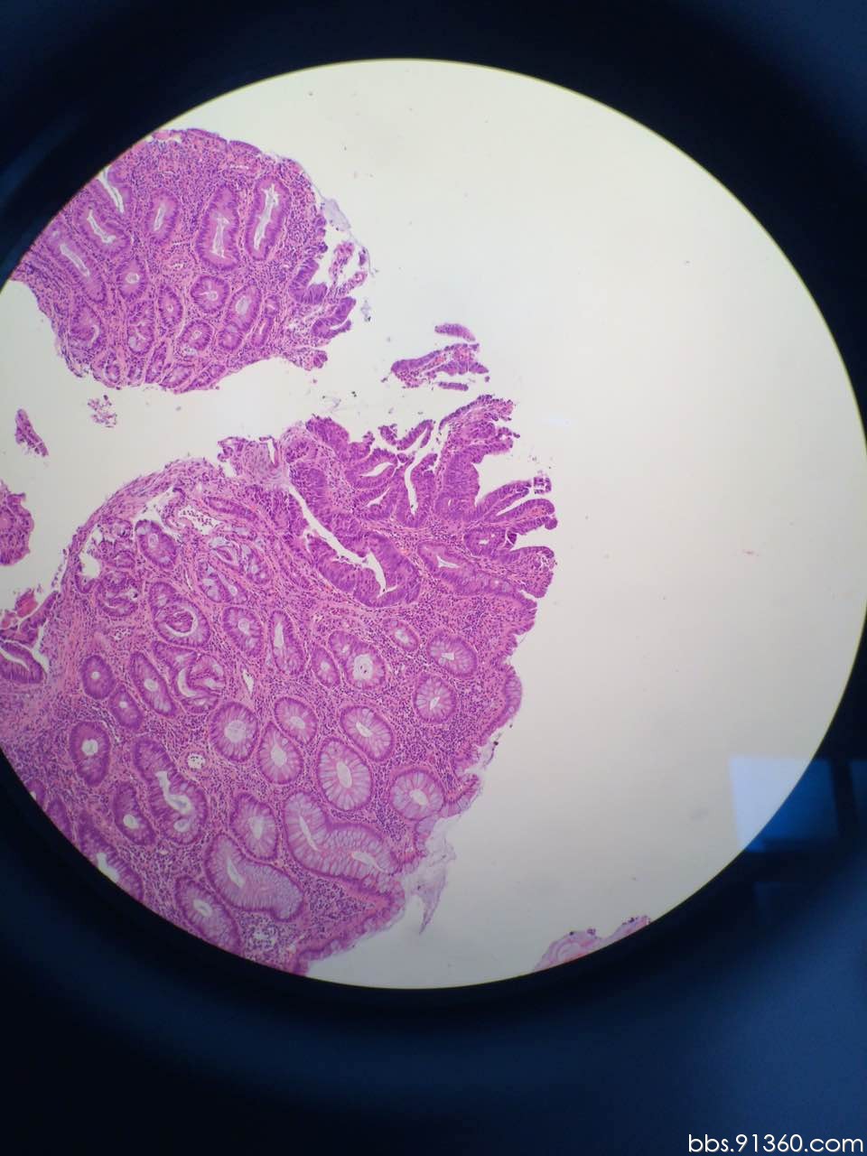 结肠腺癌显微镜图片图片