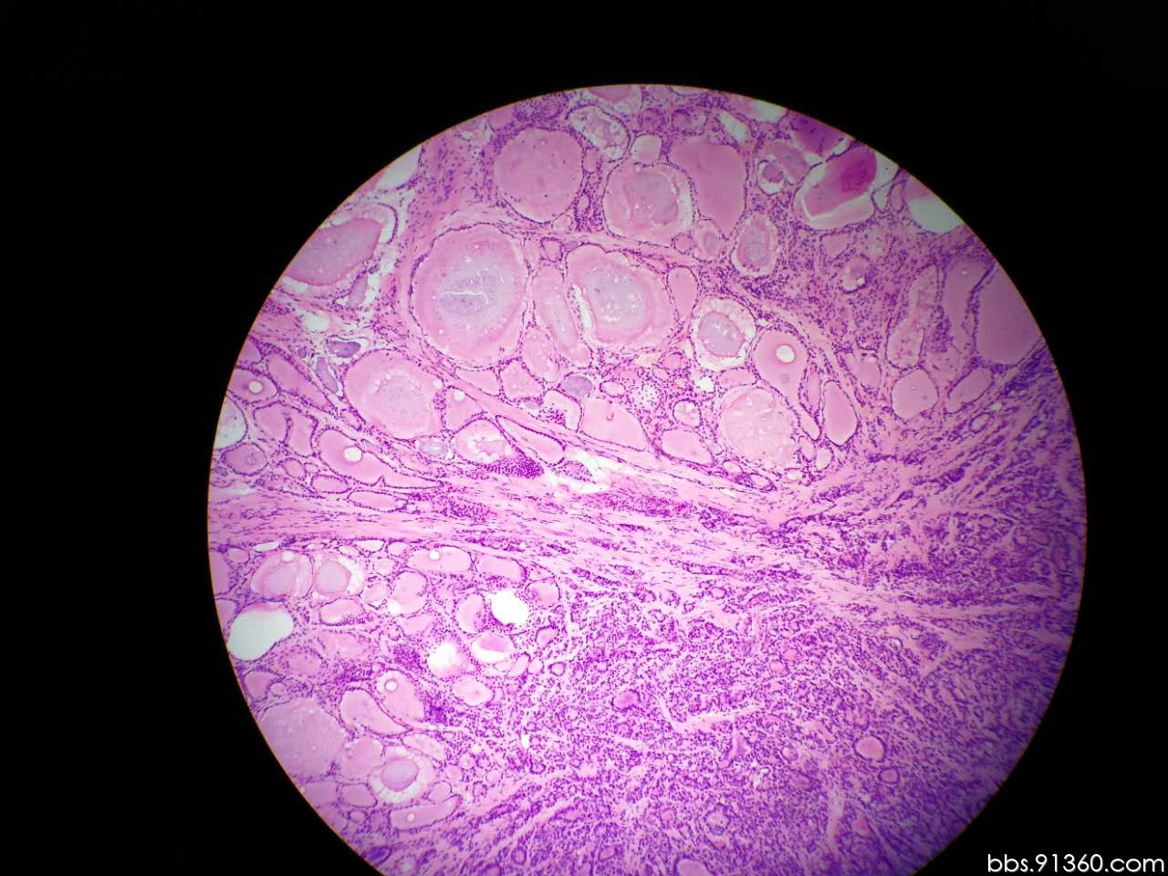 甲状腺癌切片图片图片