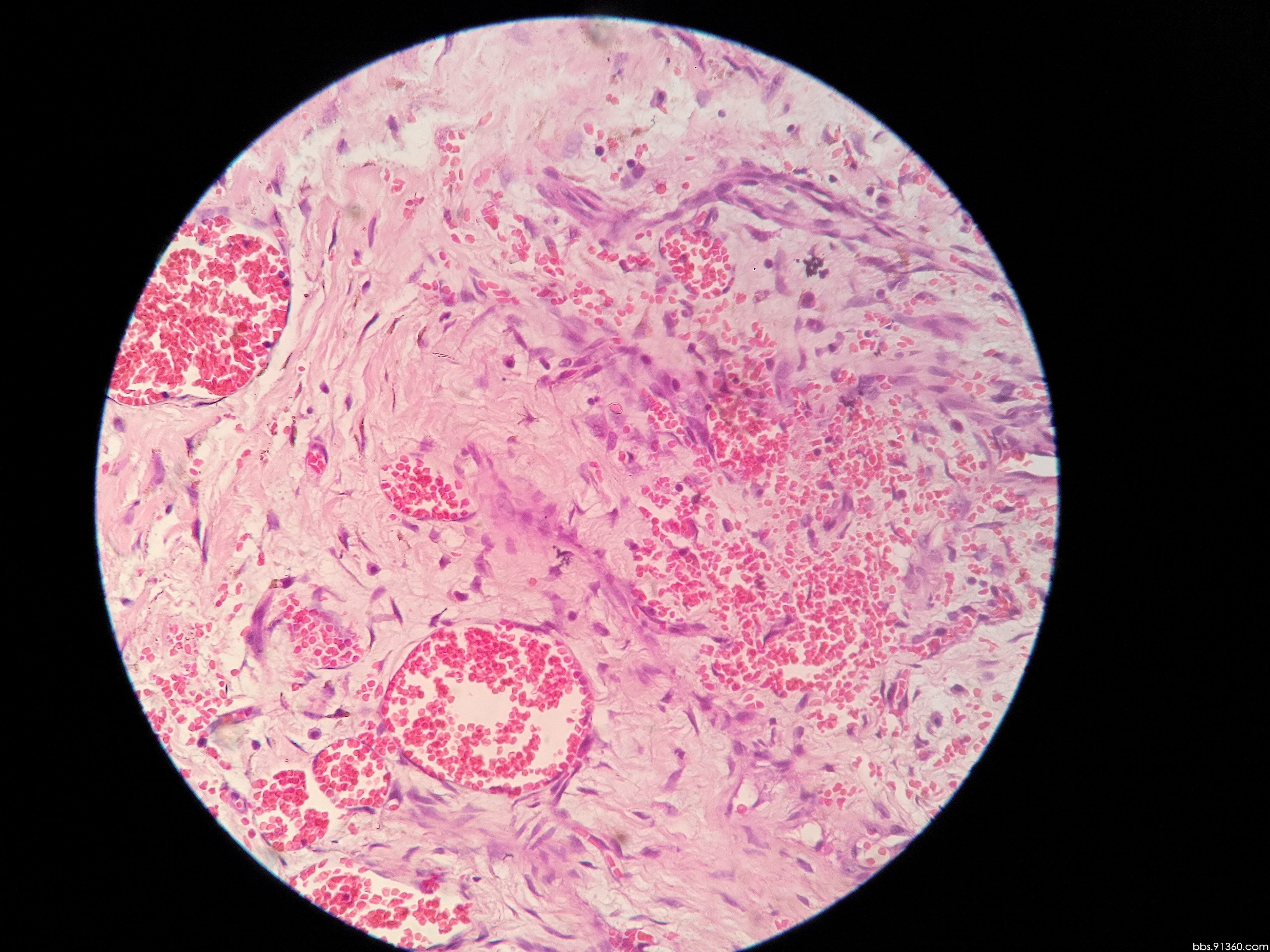 是蔓状血管瘤吗?路过的老师帮看看