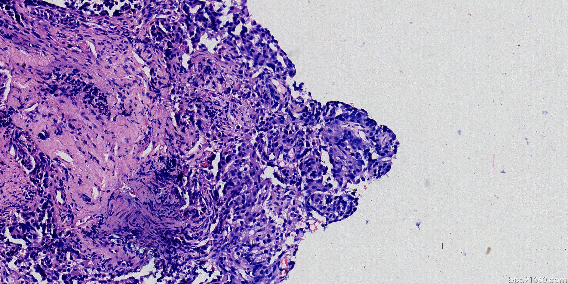 喉部鳞状细胞癌图片