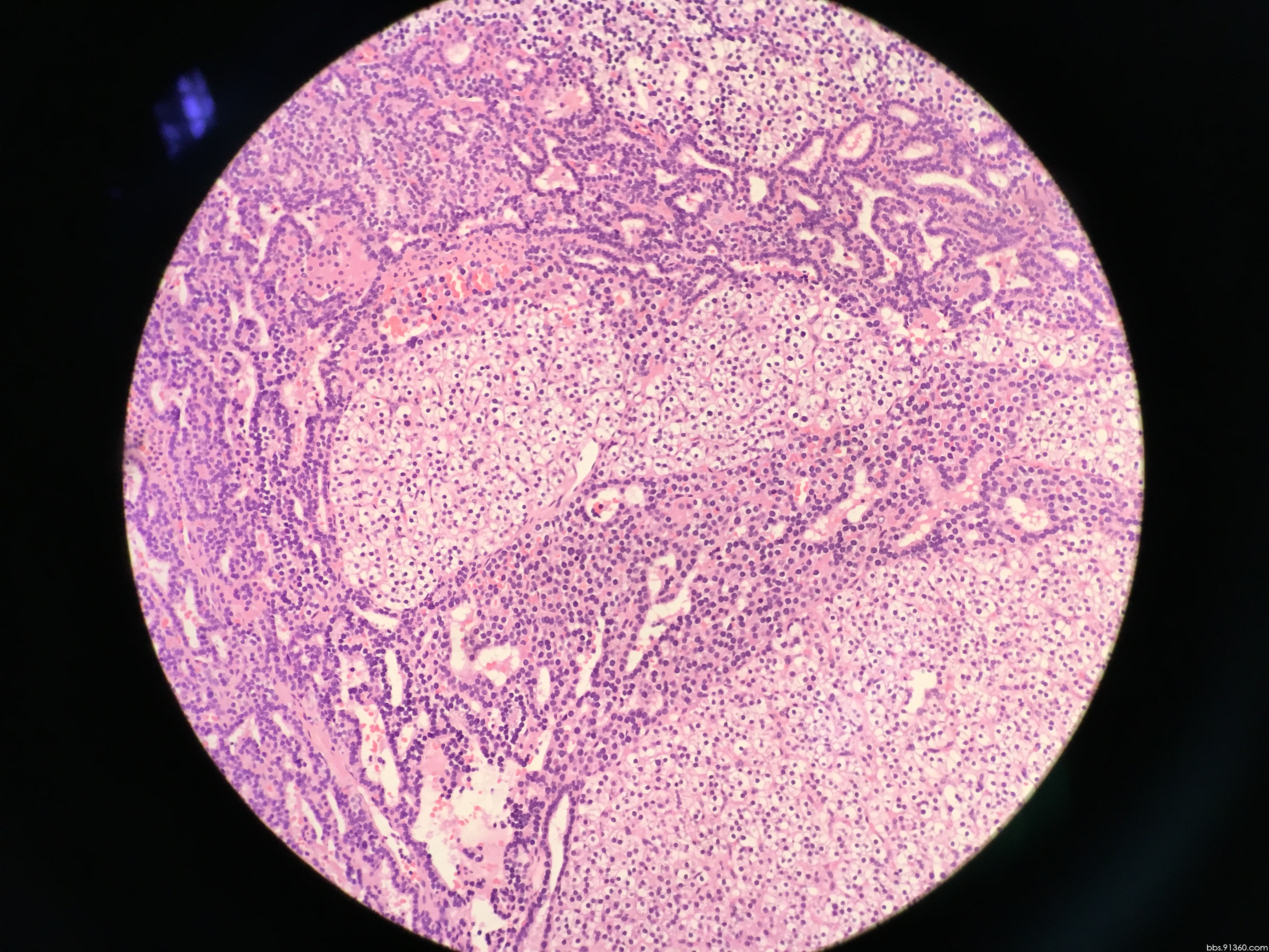 甲状腺右叶结节