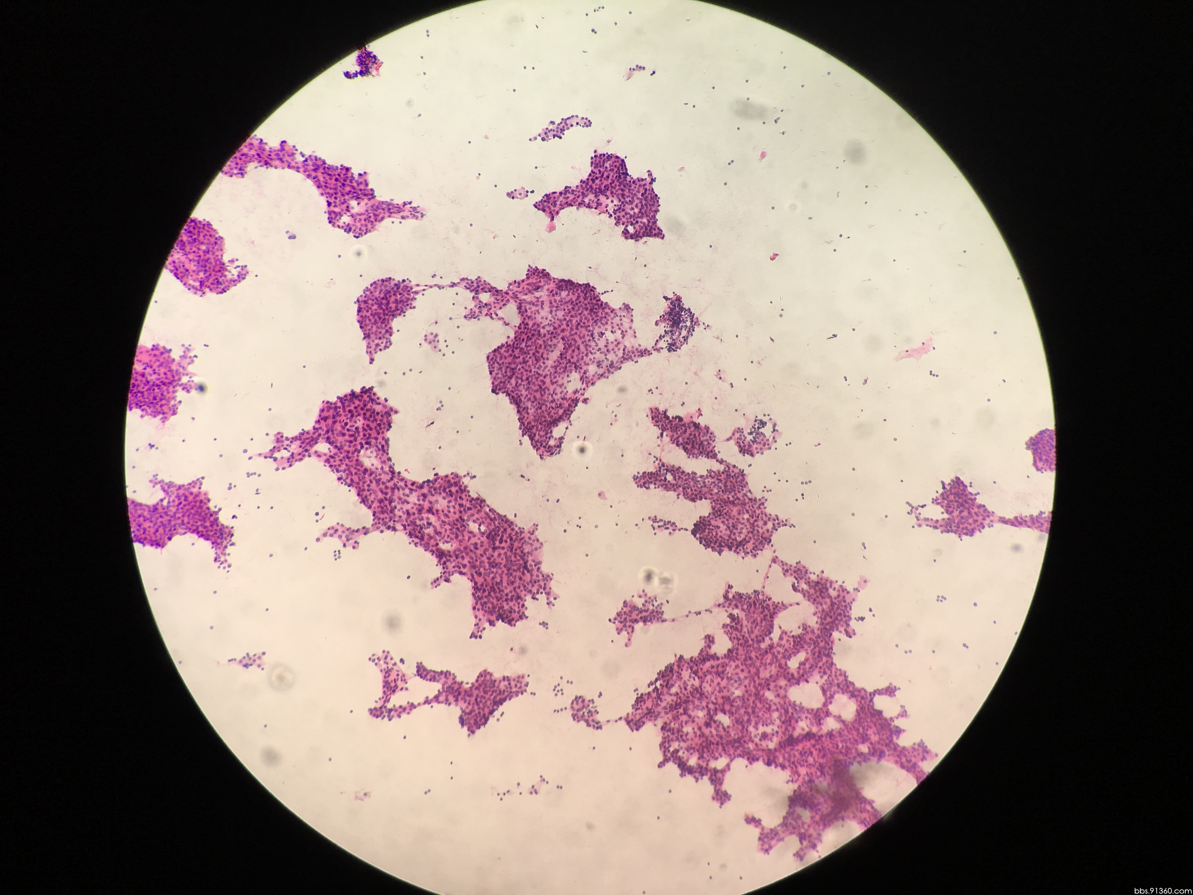 甲状旁腺病变讨论病例【中美加非妇科细胞学交流群病例42】