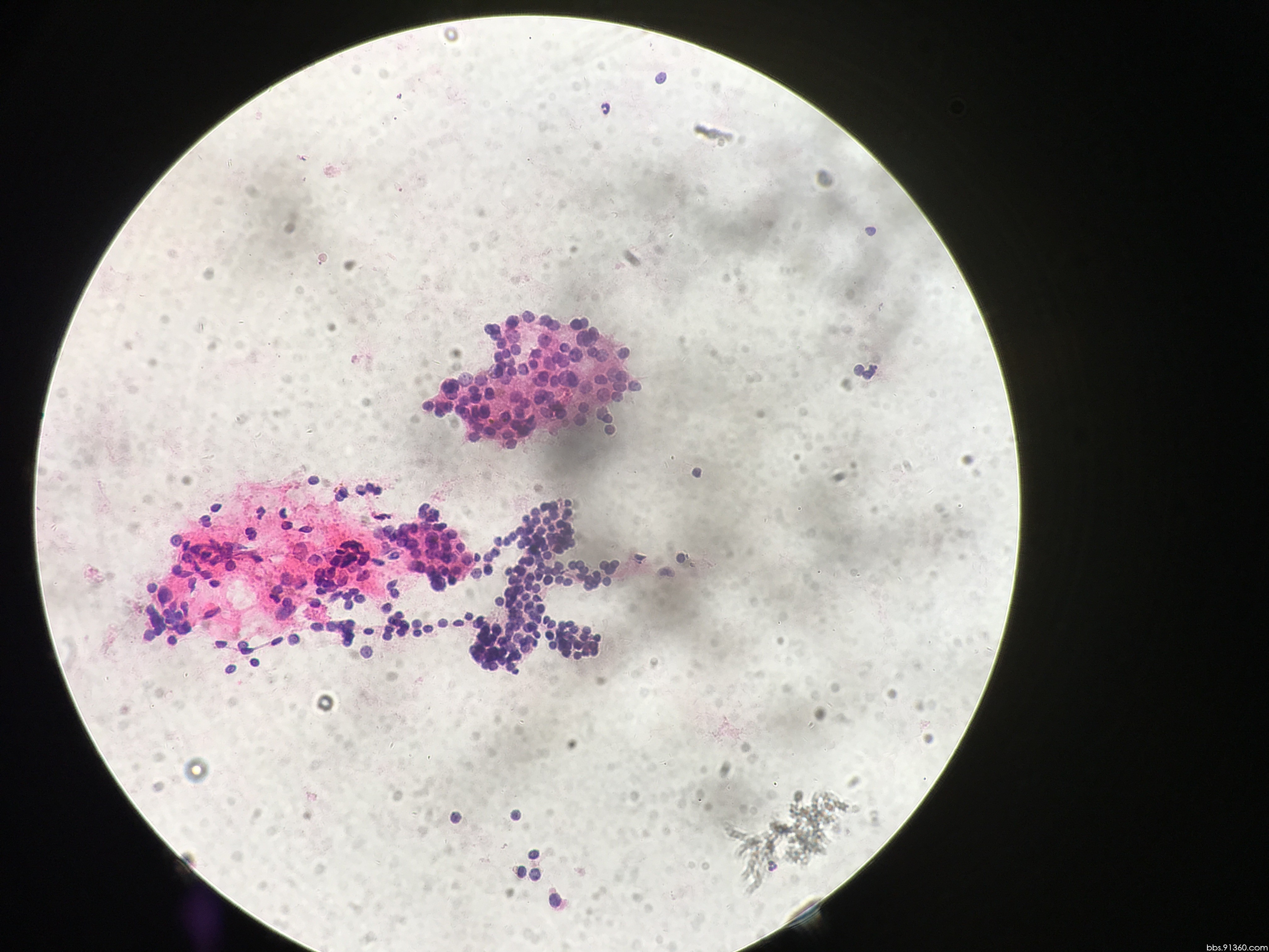 甲状旁腺病变讨论病例【中美加非妇科细胞学交流群病例42】