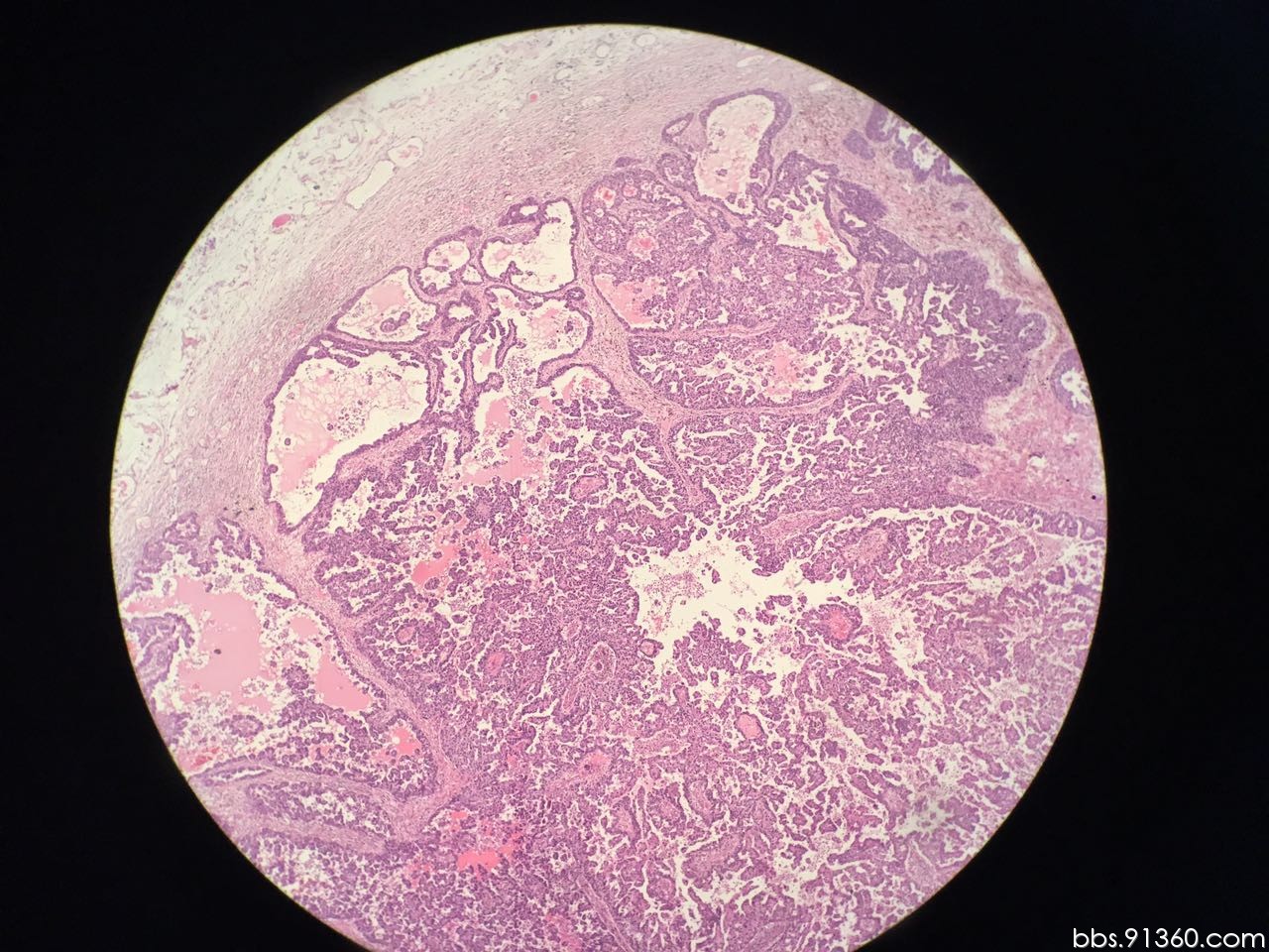 乳腺乳头状癌一例2017.8.30【中美加乳腺病理交流群病例153】