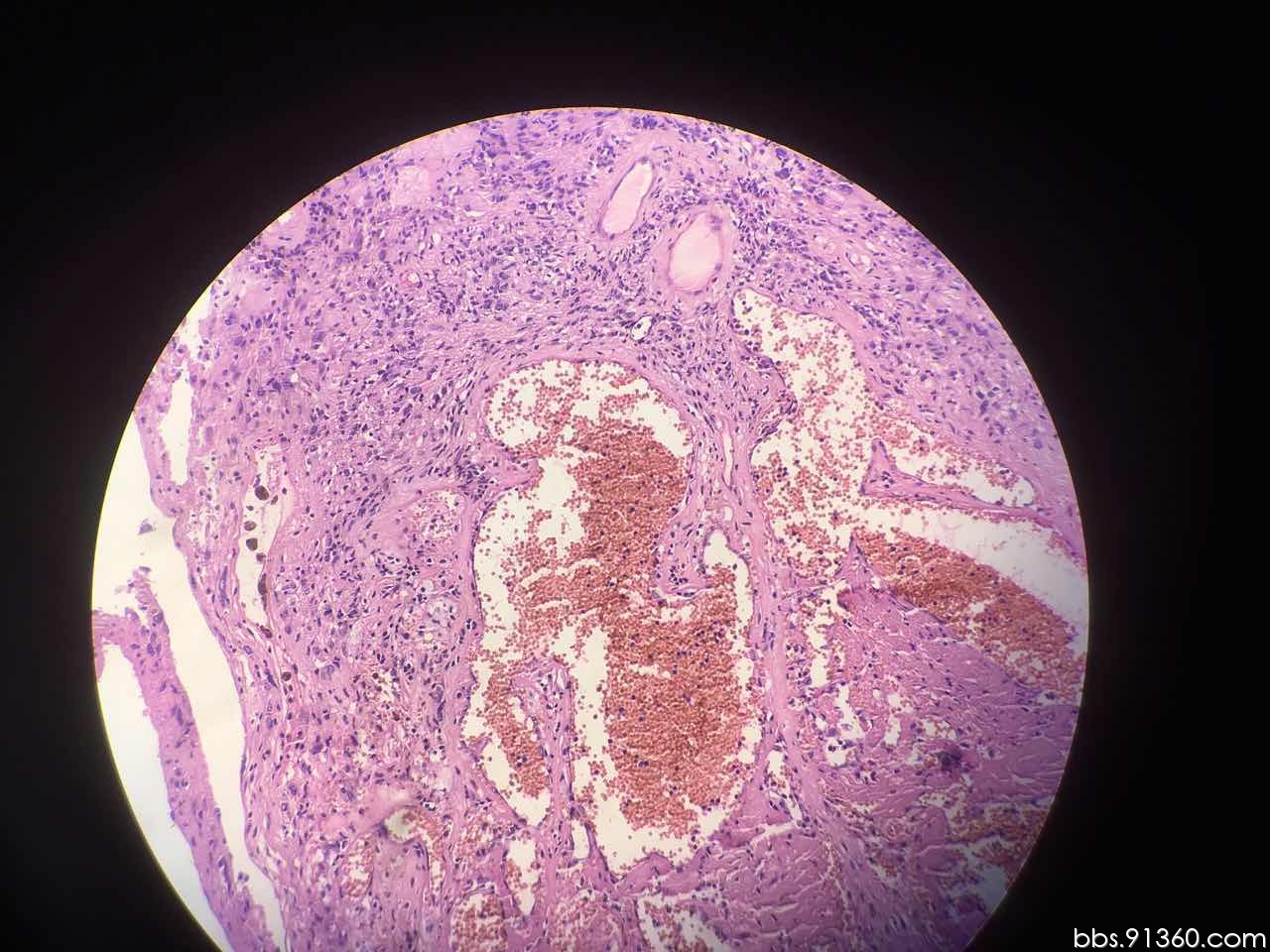 右肩皮下肿物 陈旧性神经鞘瘤?讨论【91360软组织病理沙龙111】