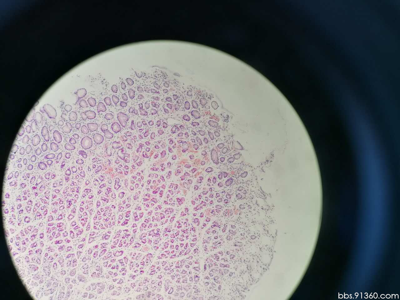 静脉扩张淤血讨论2017.09.20【91360消化病理沙龙病例讨论327】