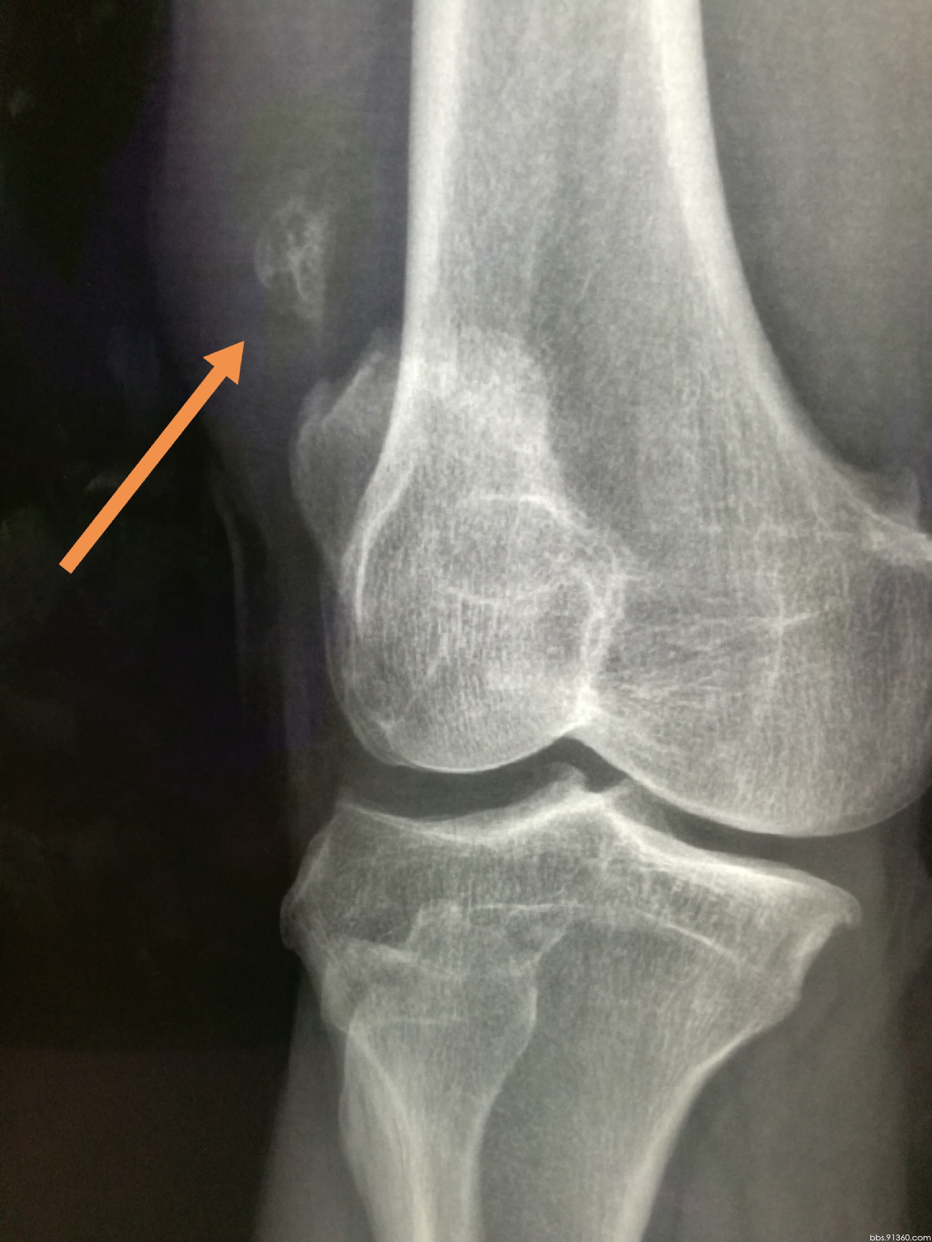 膝关节CT解剖-外科学-医学
