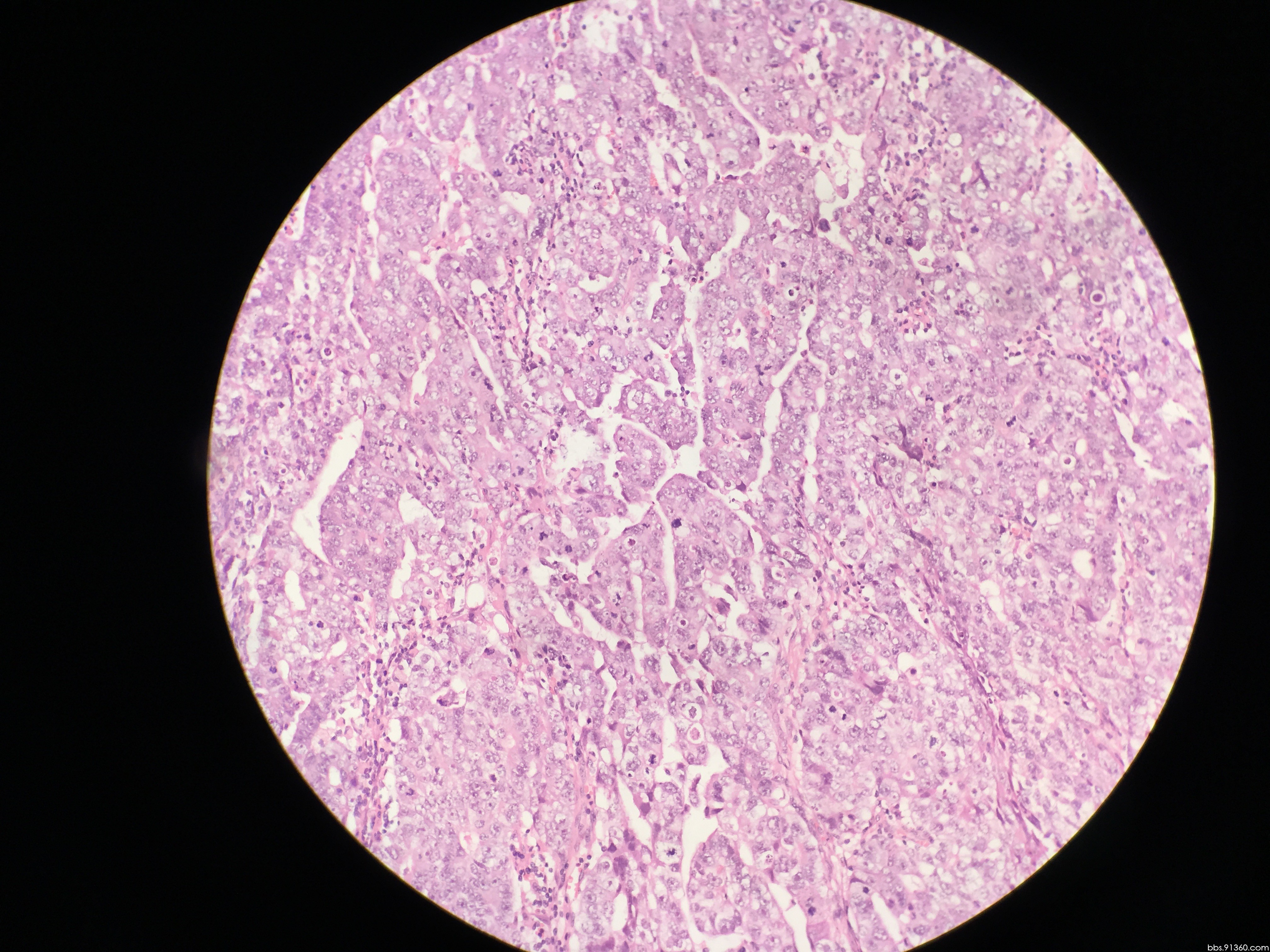 右睾丸肿瘤 - 泌尿和男性生殖系统 - 91360病理论坛