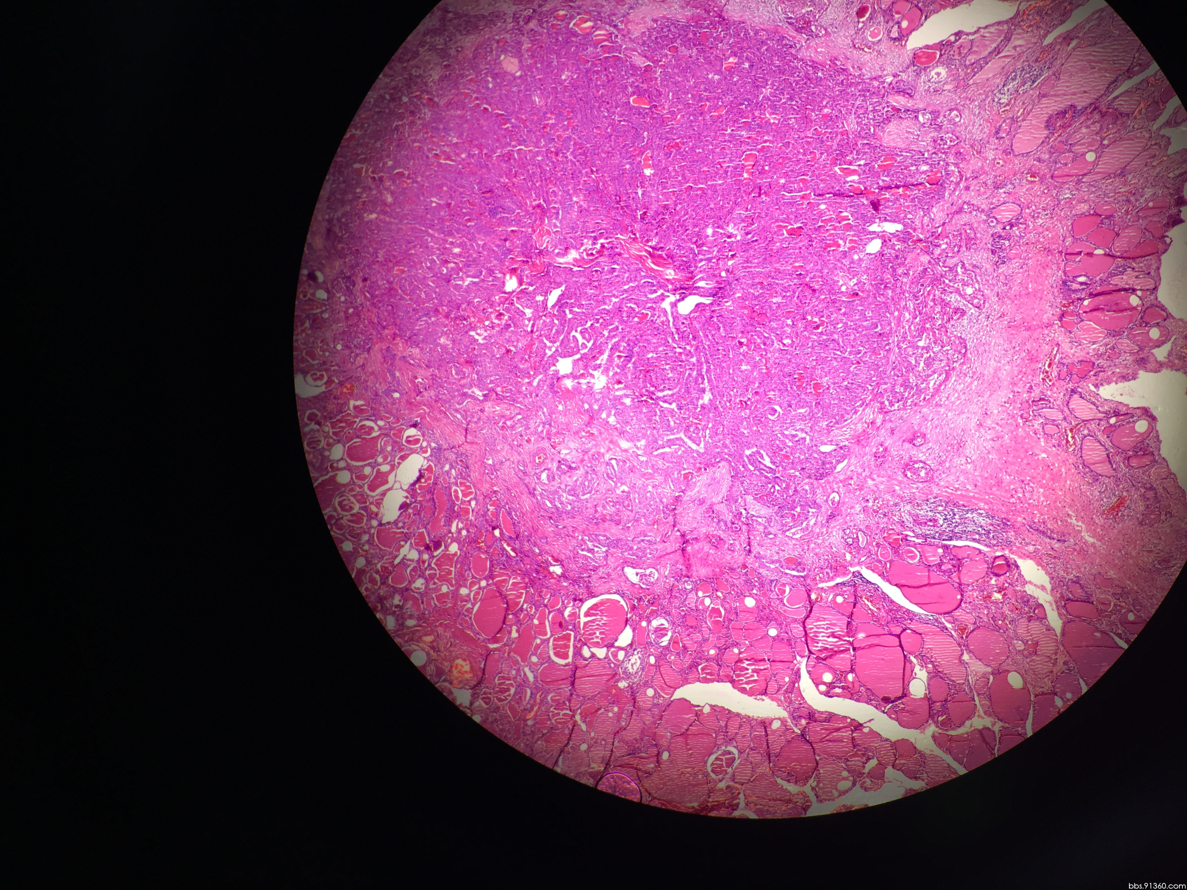 甲状腺癌切片图片图片