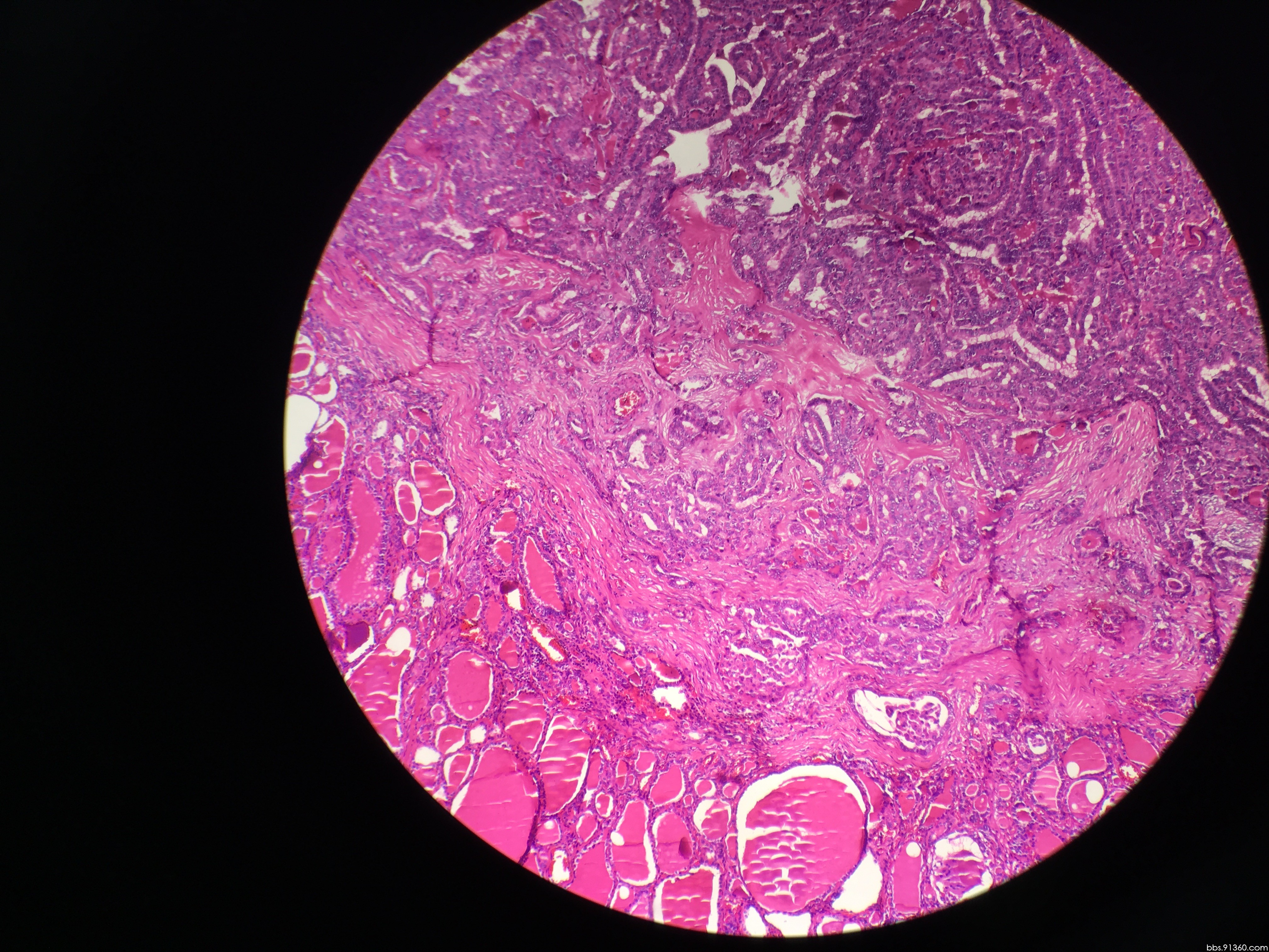 甲状腺癌切片图片图片