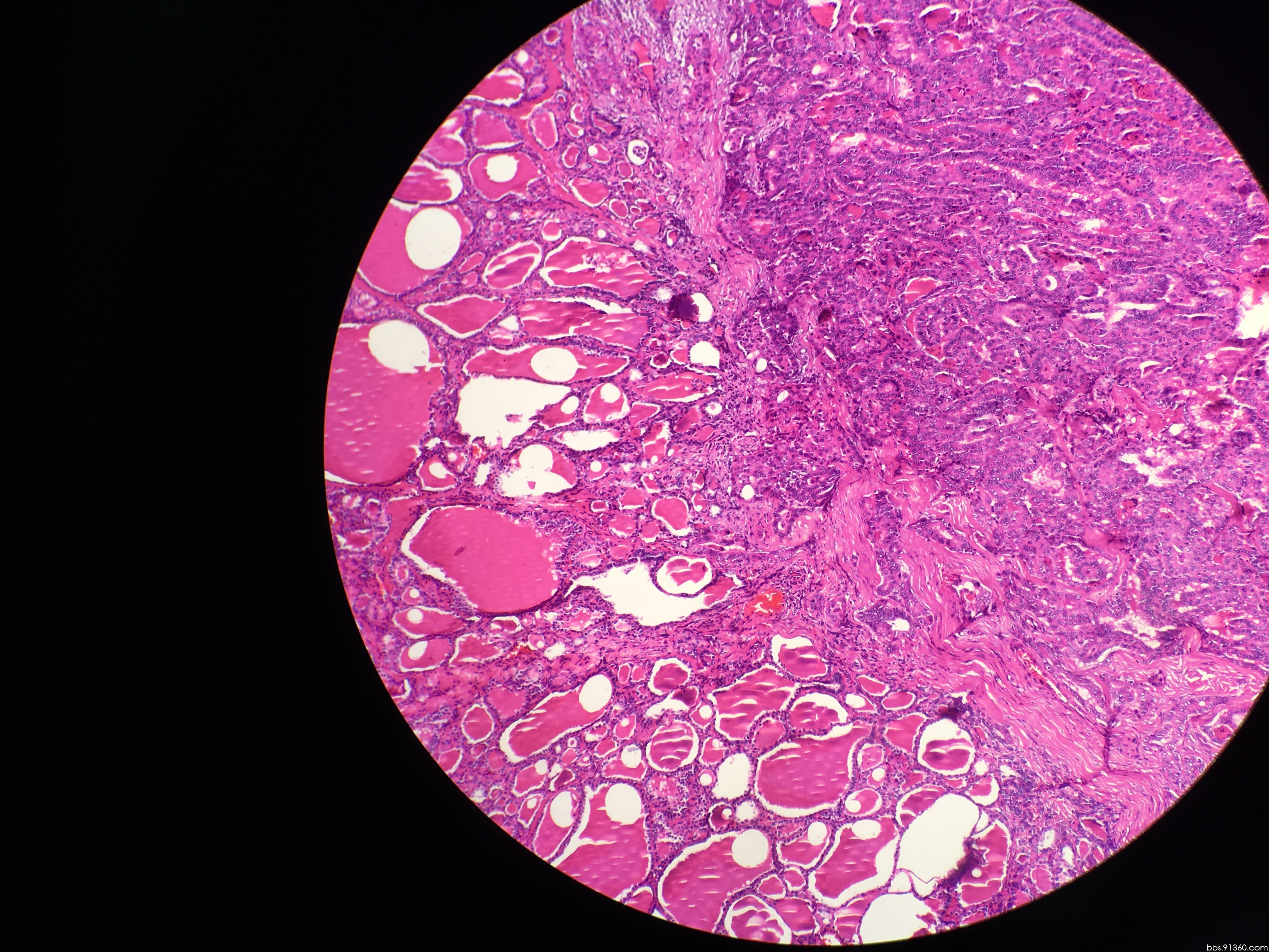 甲状腺腺瘤切片图片