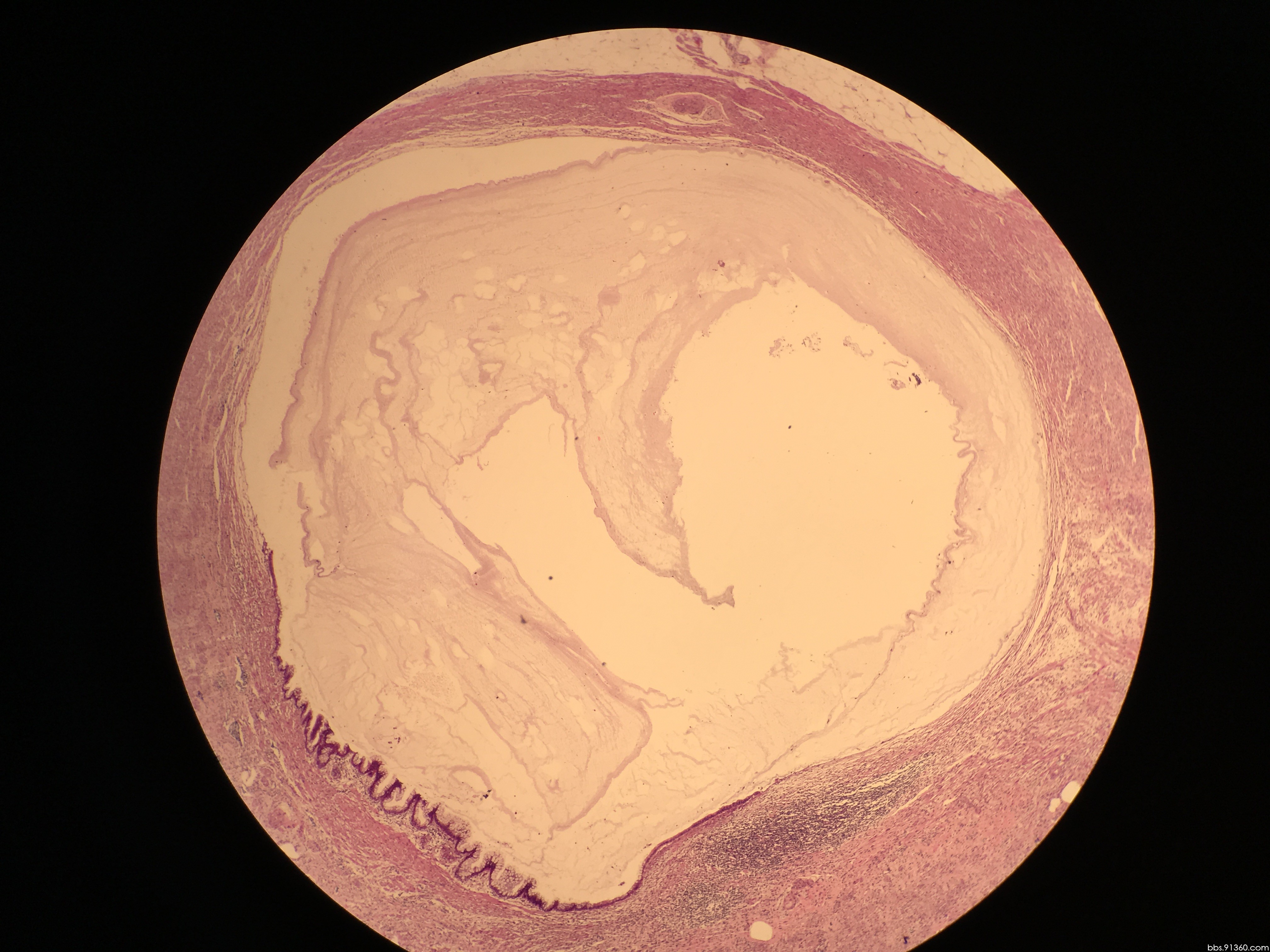 阑尾低级别粘液性肿瘤讨论2017.12.