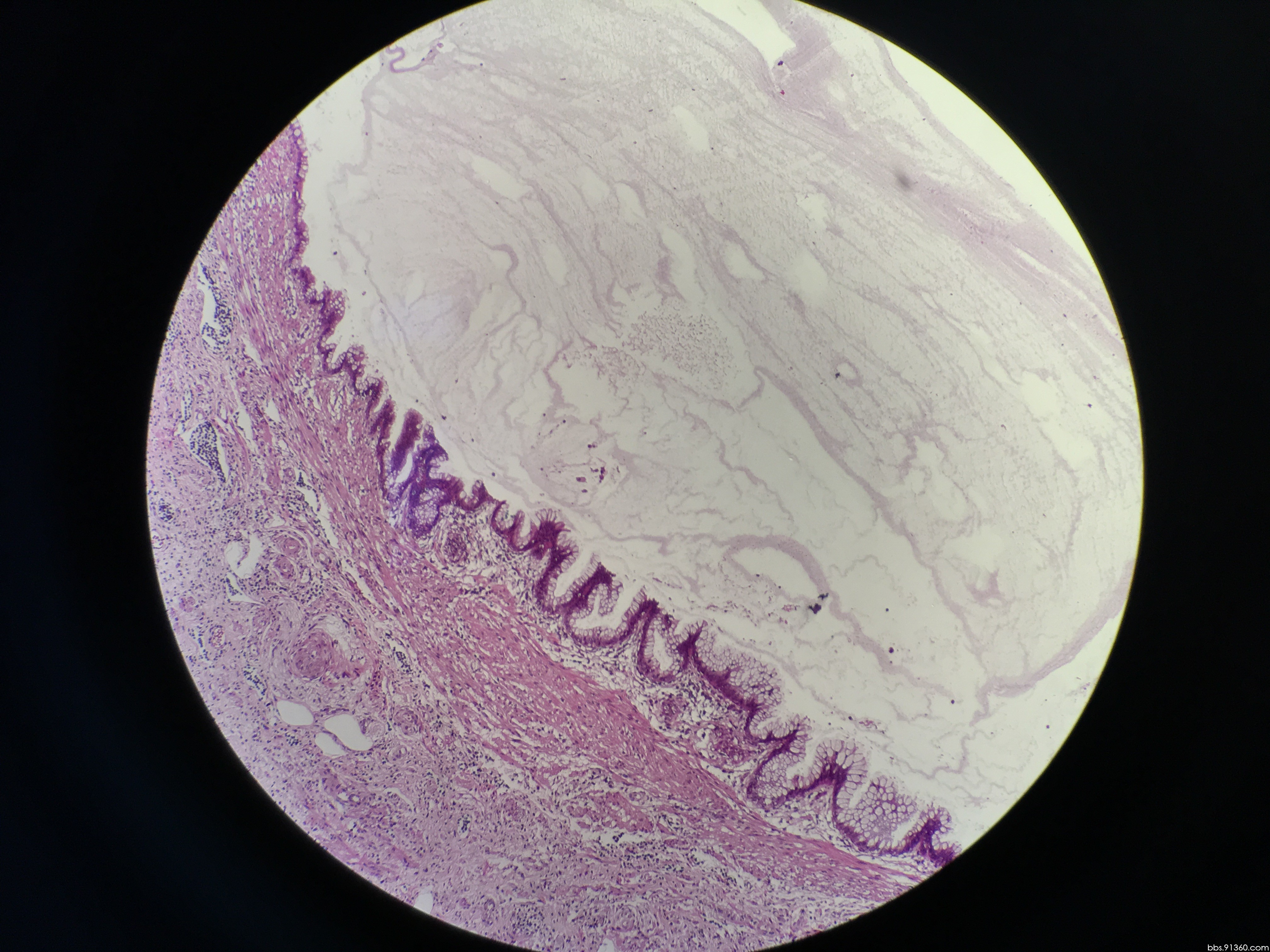 阑尾低级别粘液性肿瘤讨论2017.12.