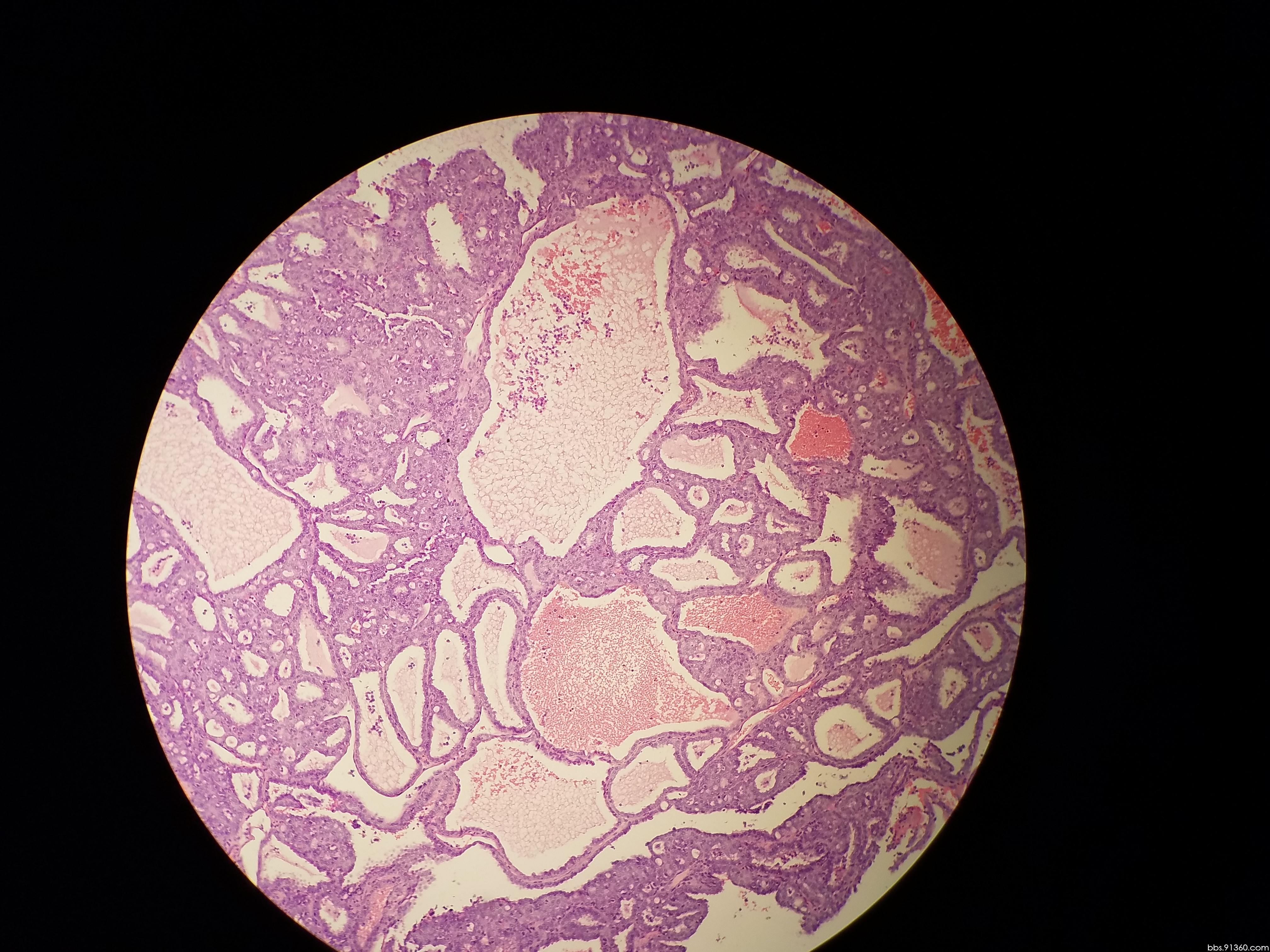 肾肿瘤 易位性肾癌讨论病例【中华病理gu学组肾脏病理交流群病例22】