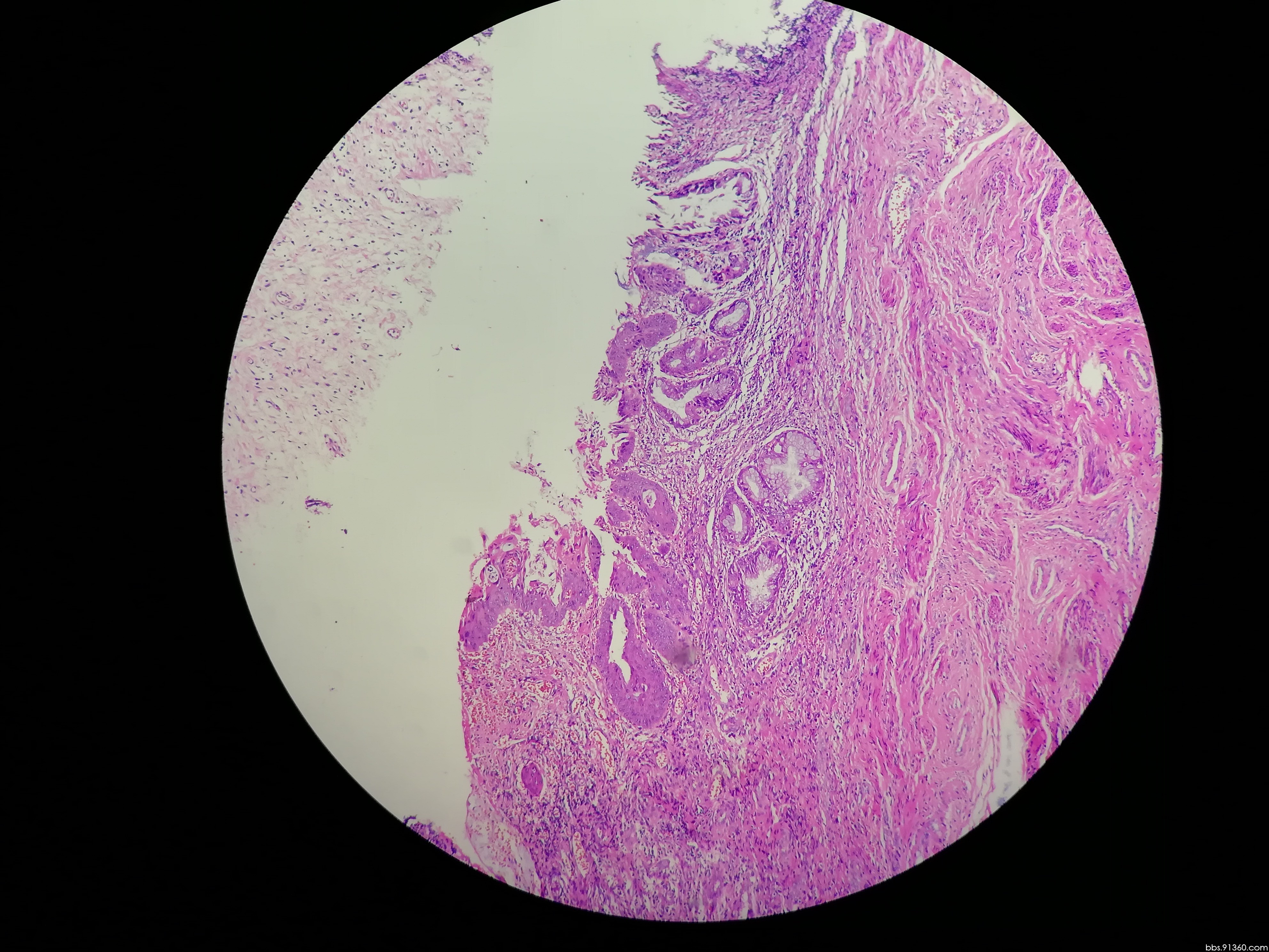 图2-125 子宫、输卵管碘油造影-妇产科学-医学
