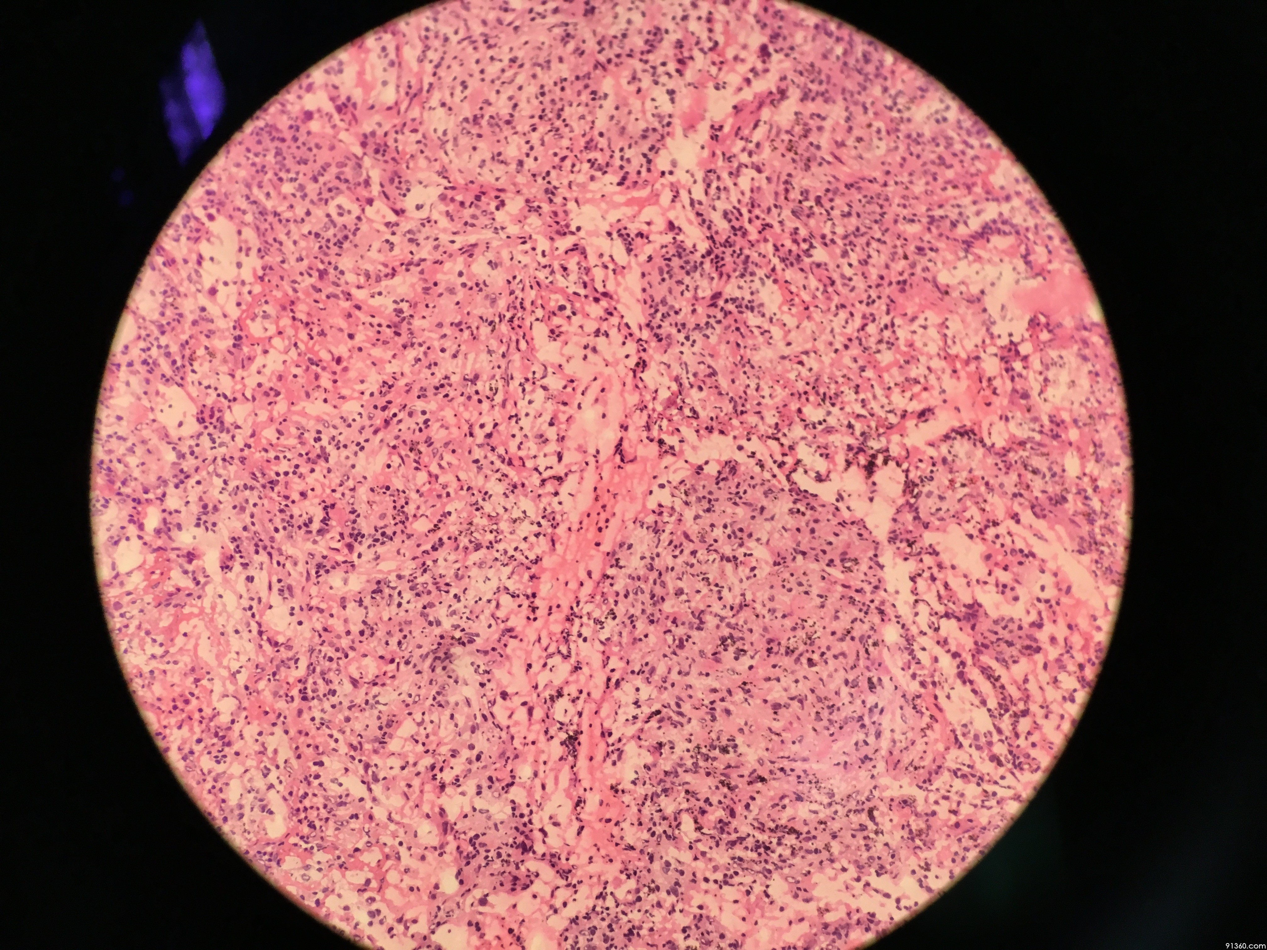 左下肺肿块,冰冻切片