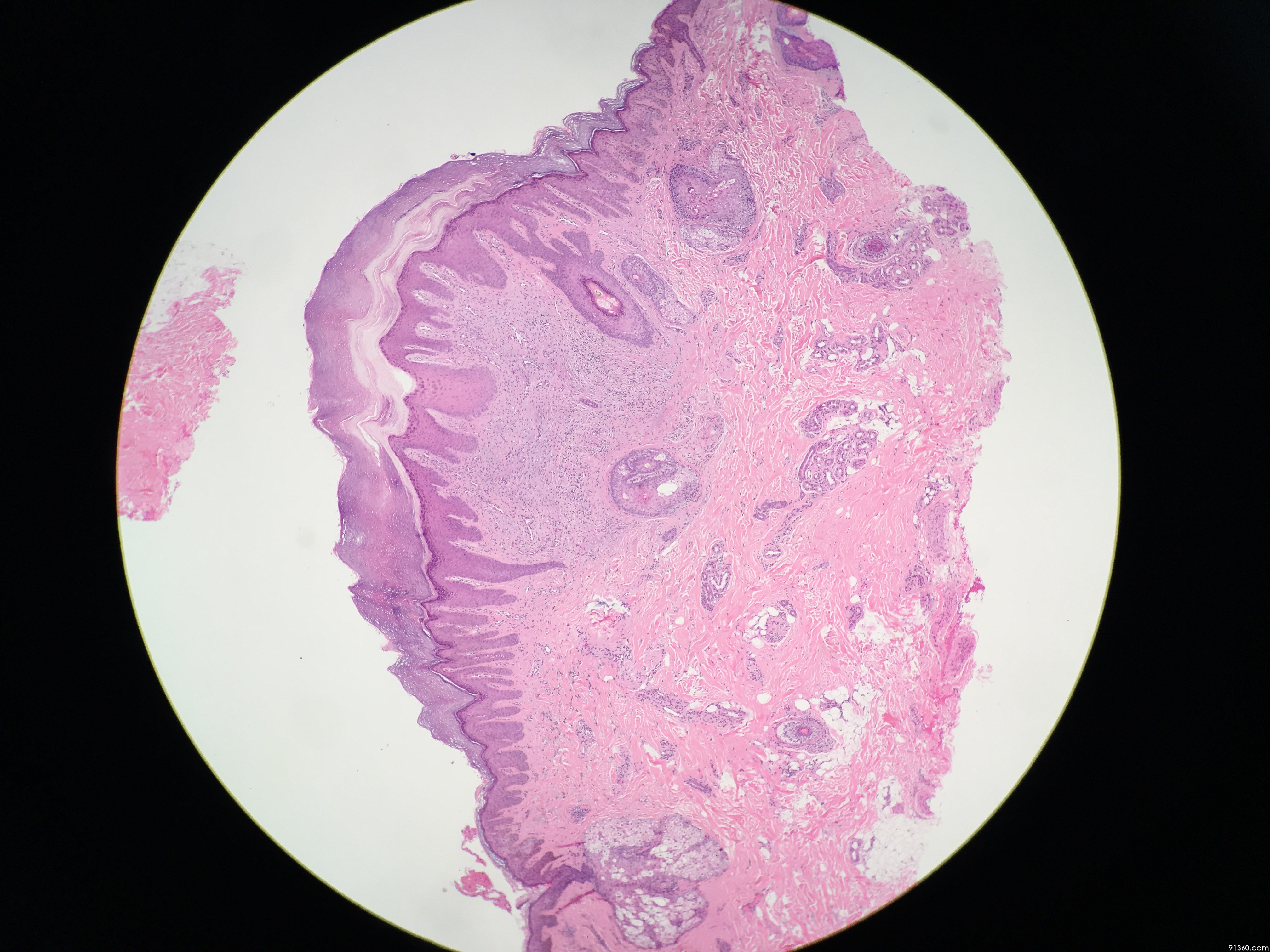 左额部皮肤结节