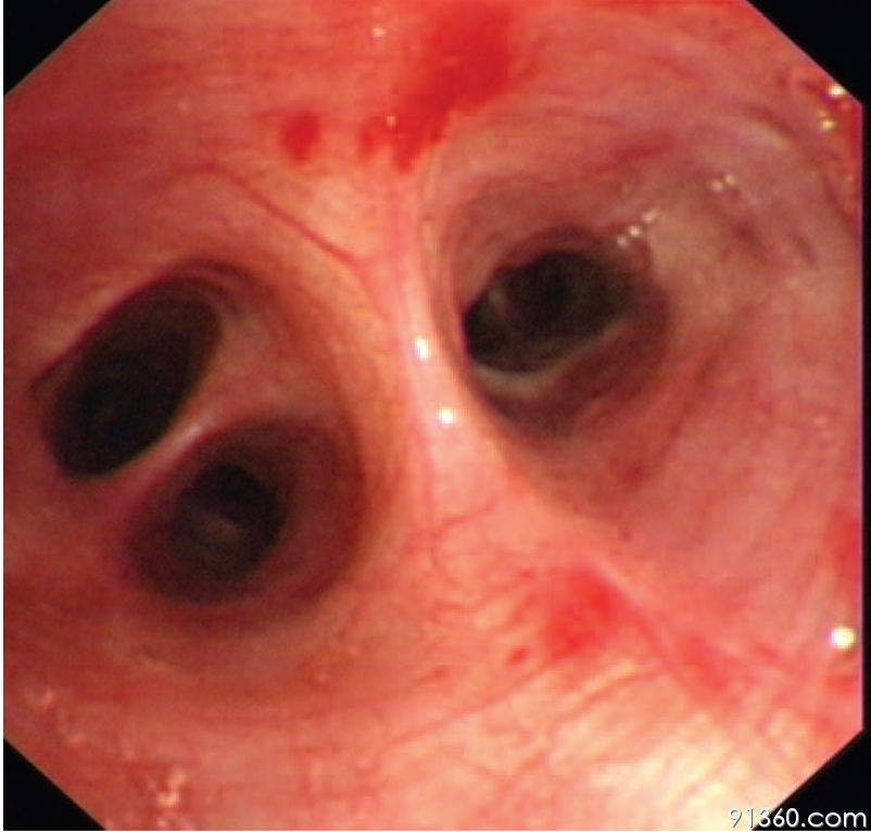 支气管镜表现无异常