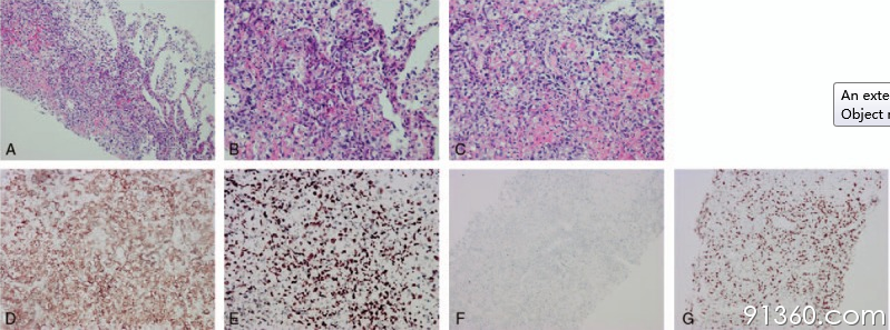 ABCHE染色见坏死及非典型淋巴样细胞，免疫组化CD3、EBER、CD56、Ki67