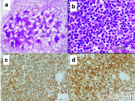 a瘤细胞位于肺泡间隙，肺泡壁保存；b非典型淋巴样细胞，c CD20，d,BCL2