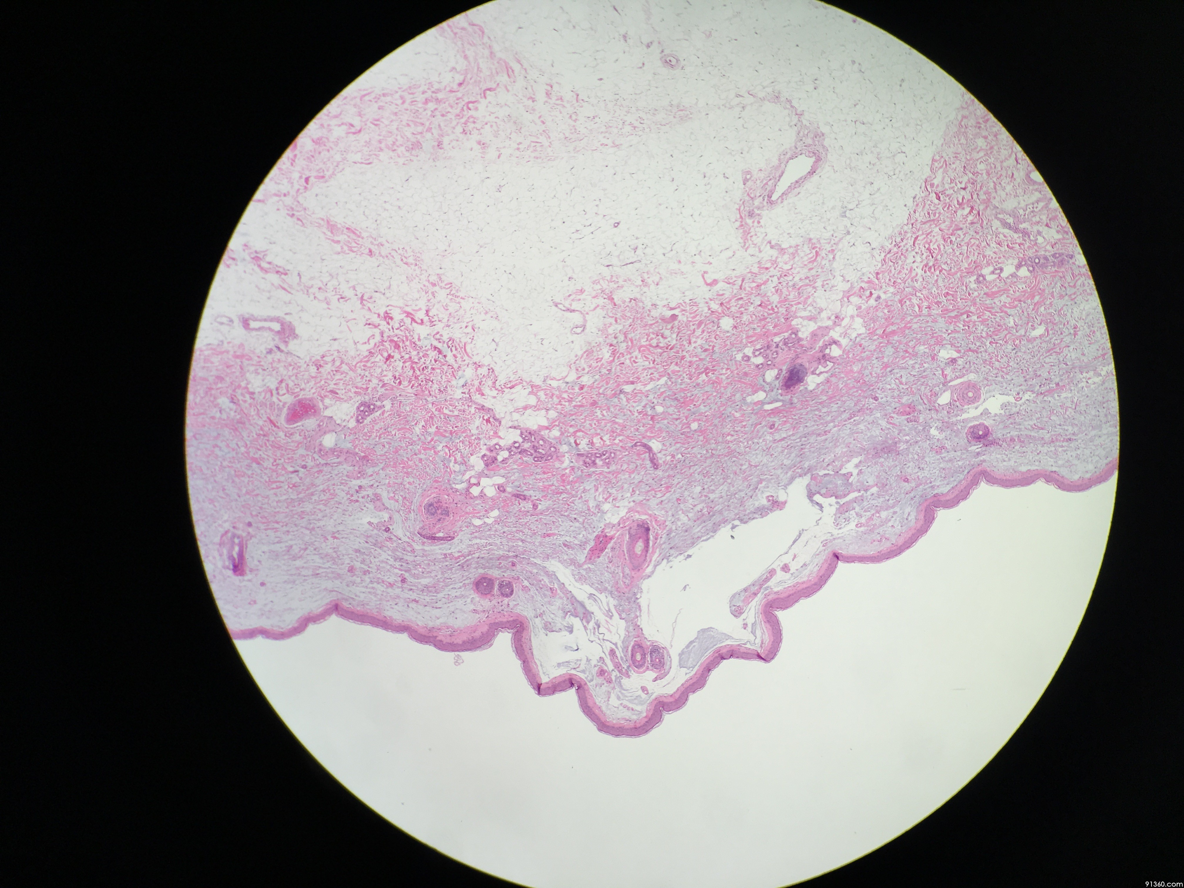 颈部皮肤 - 皮肤病理 - 91360病理论坛