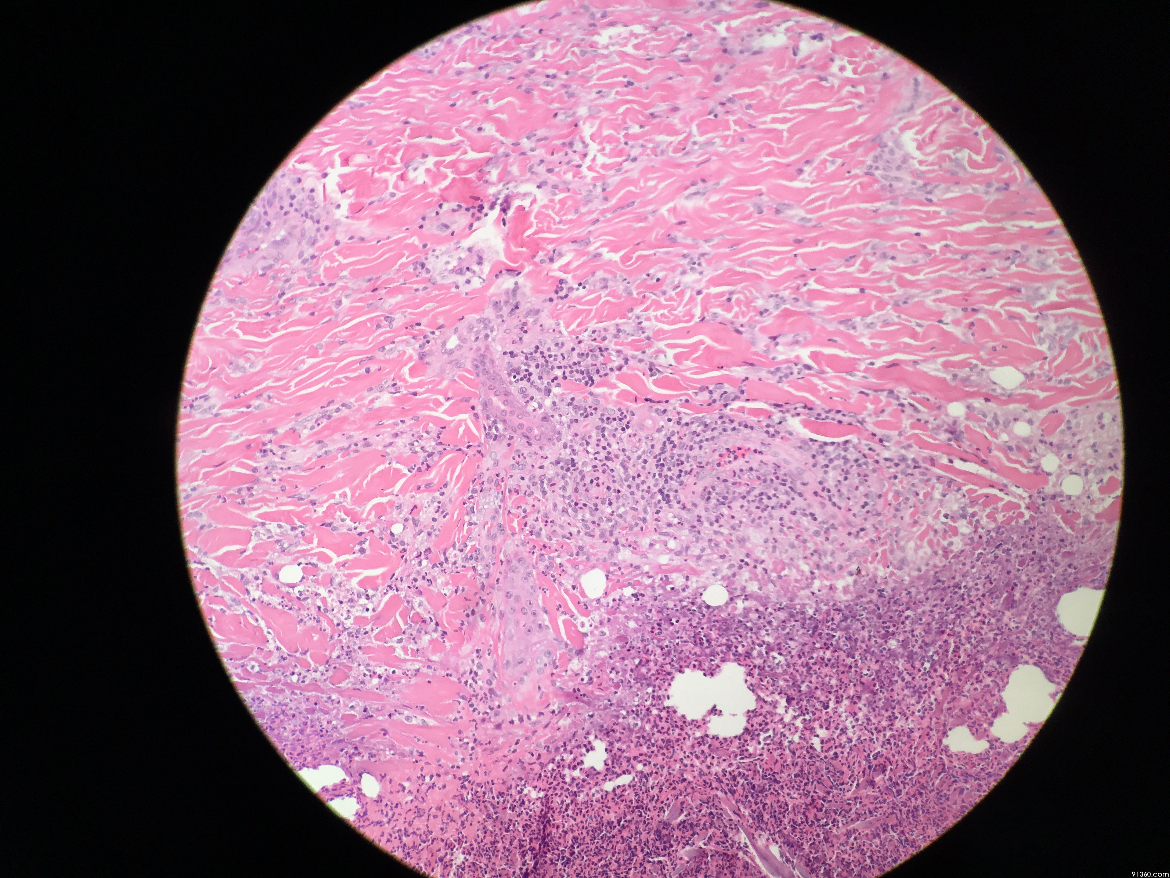 手背皮肤溃疡 - 皮肤病理 - 91360病理论坛