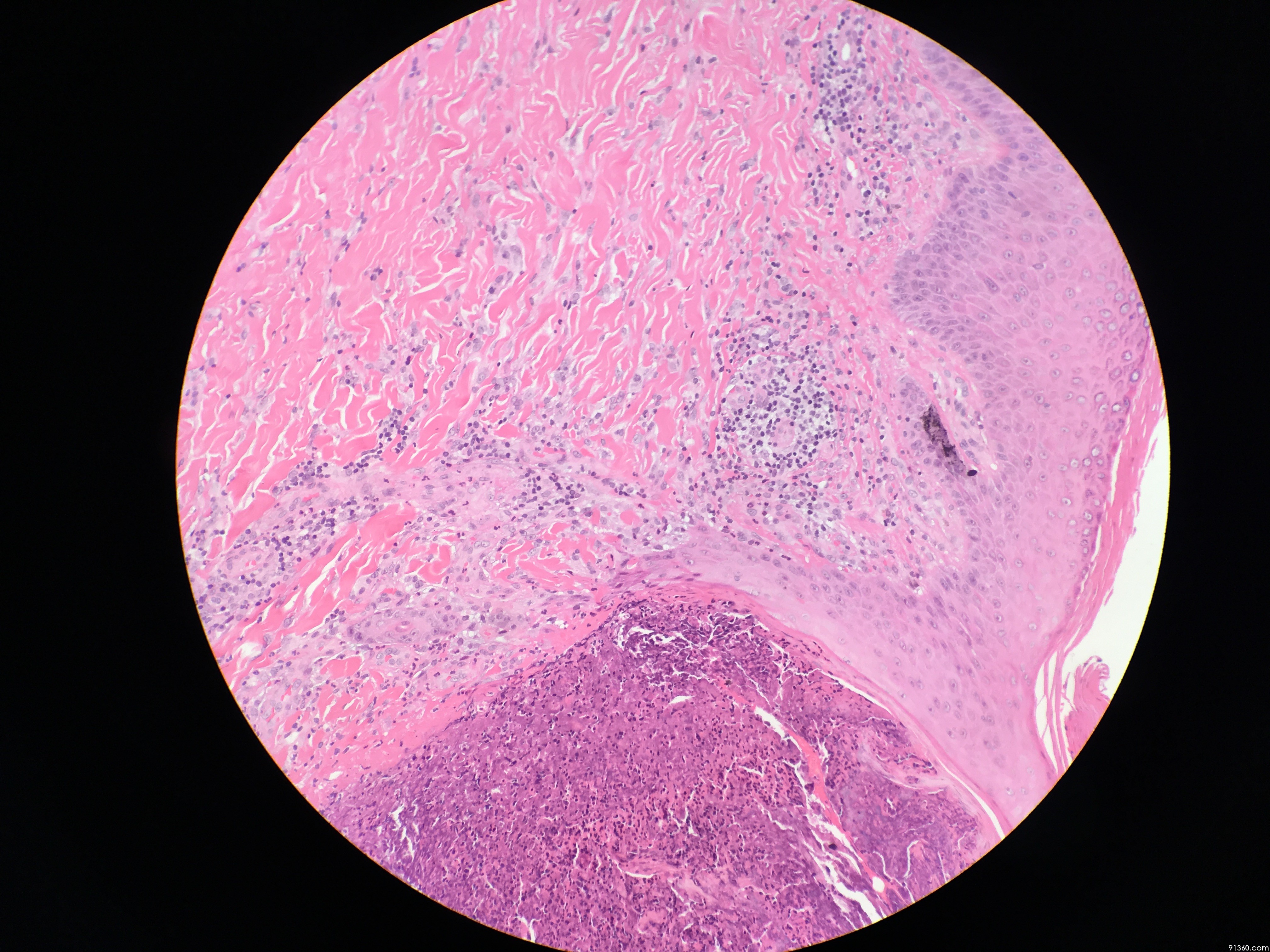 手背皮肤溃疡 - 皮肤病理 - 91360病理论坛