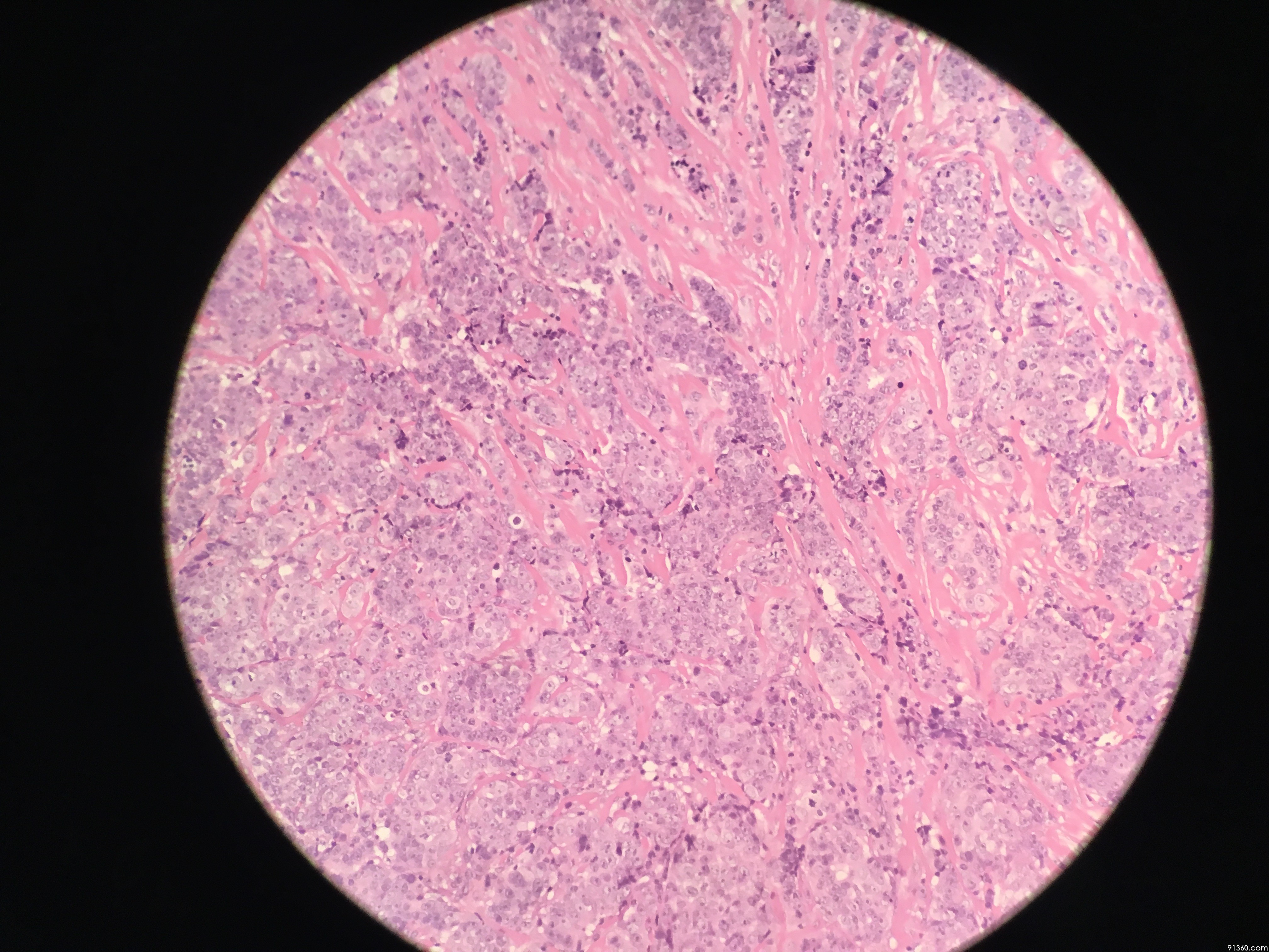 右腋窝淋巴结肿大