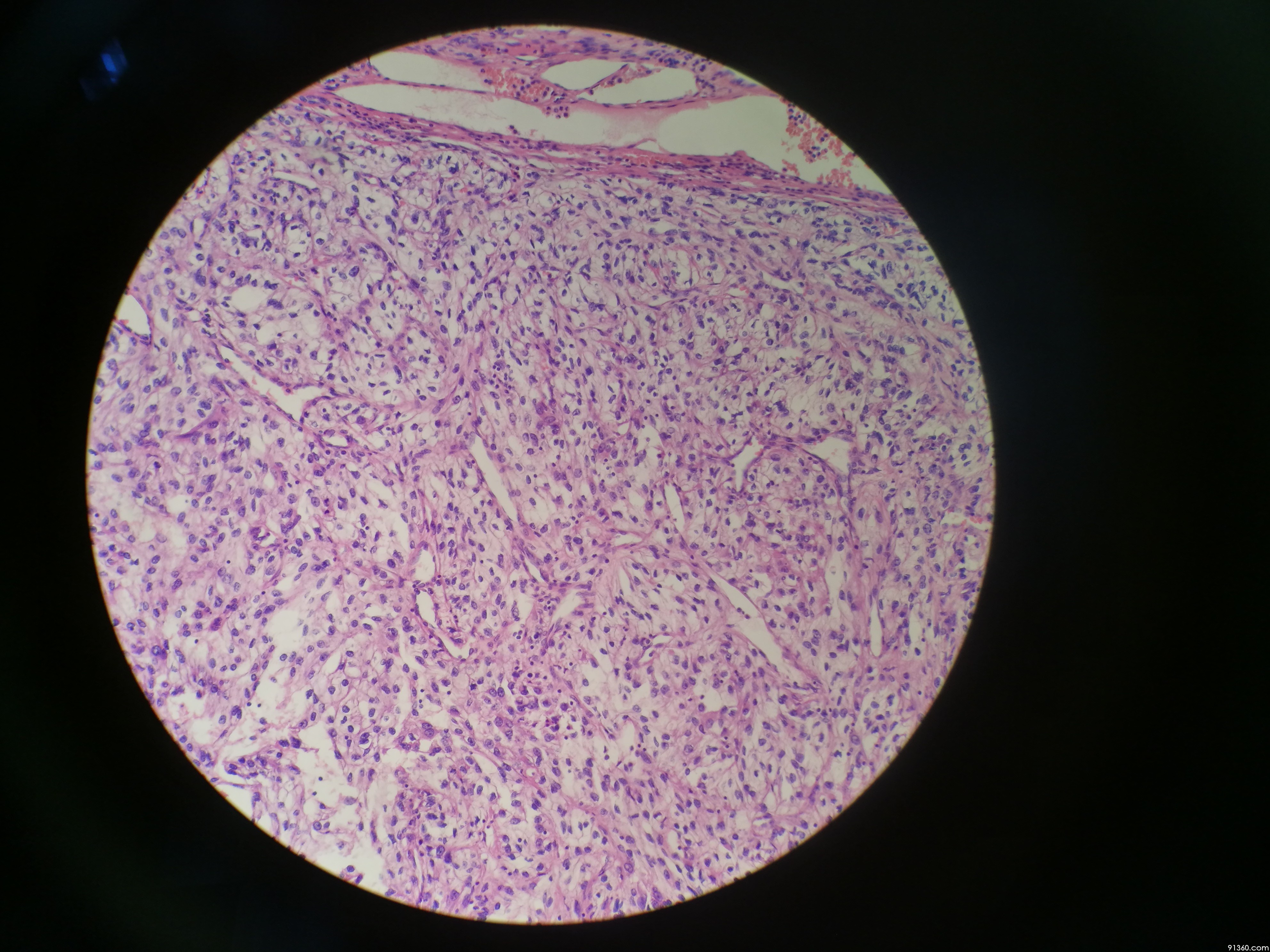 左肾透明细胞癌图片