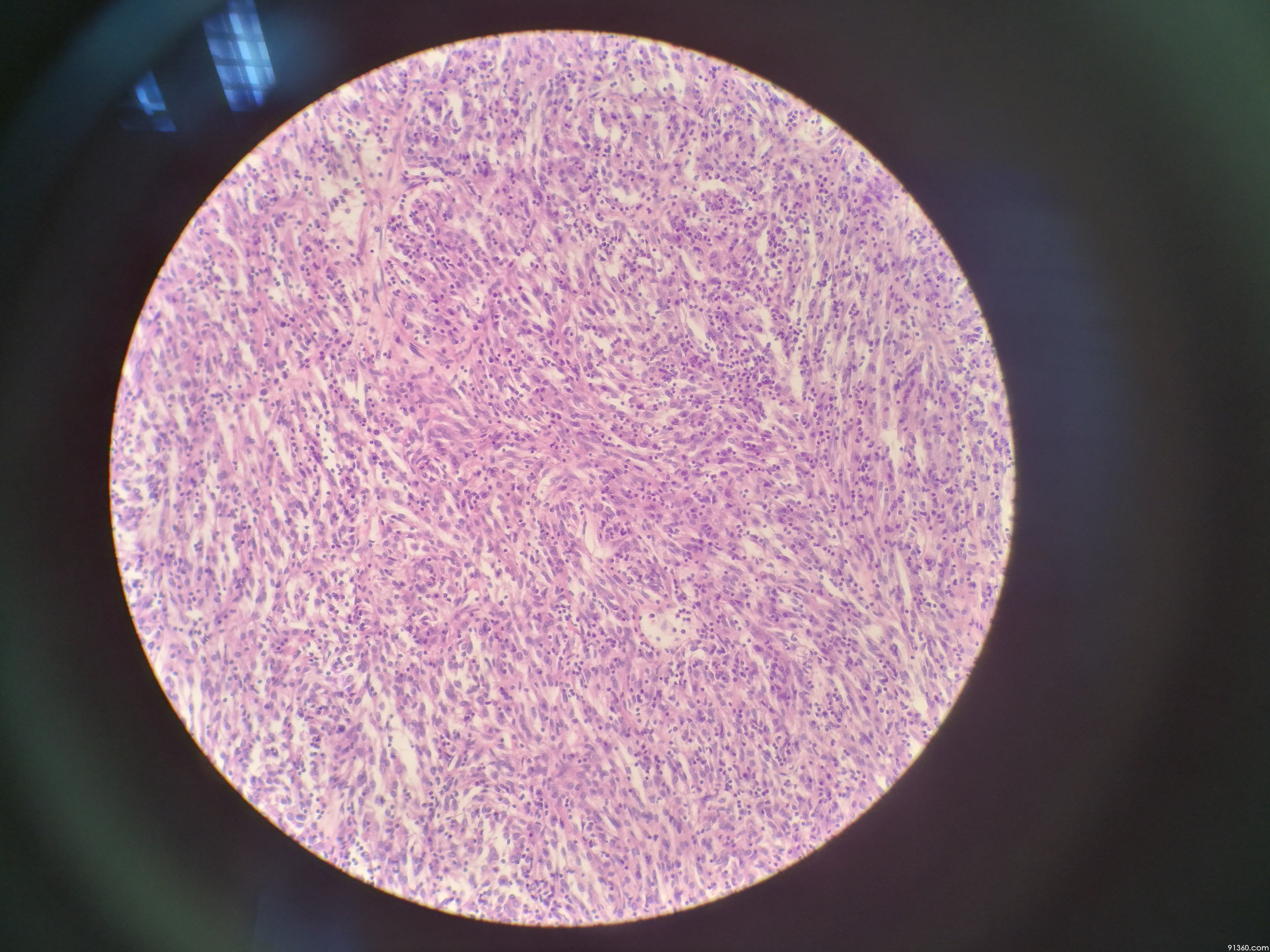透明细胞肉瘤外观图图片