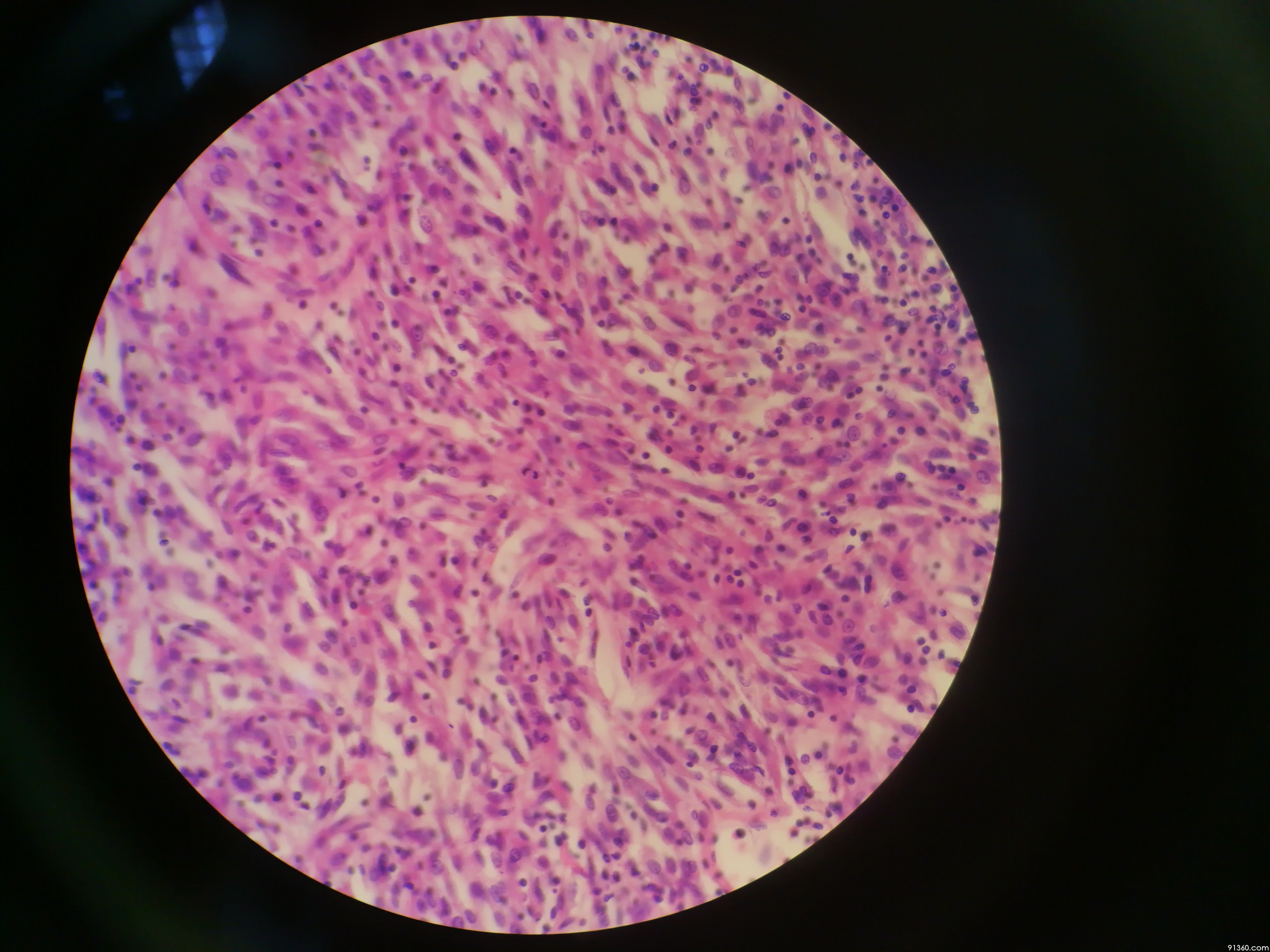 透明细胞肉瘤图片图片