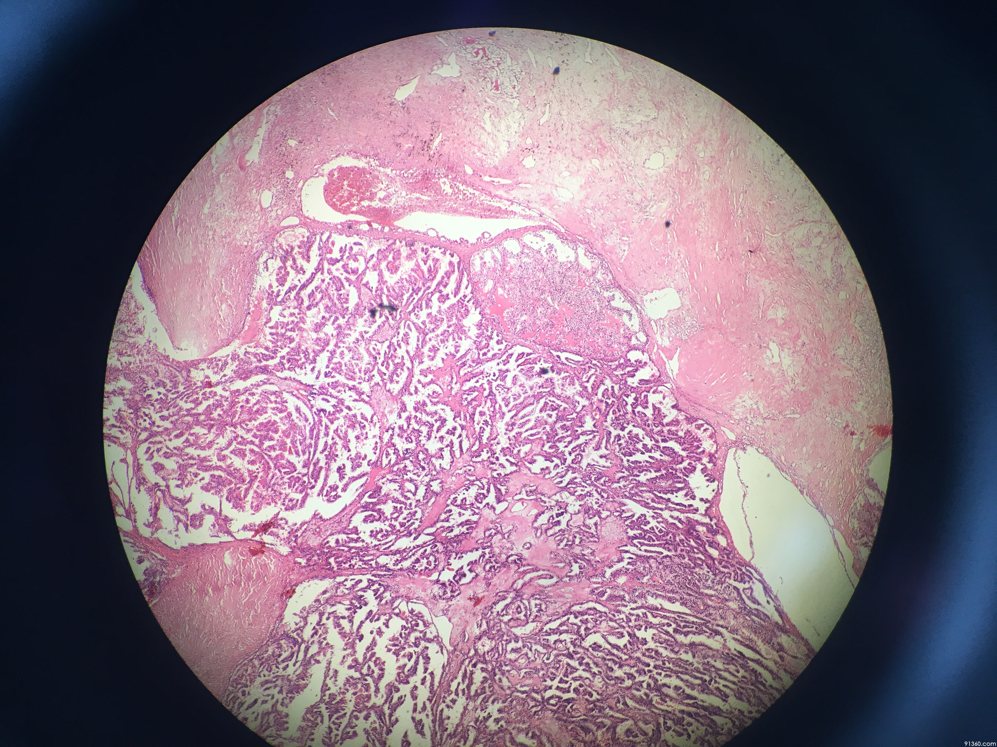 左肾透明细胞癌图片