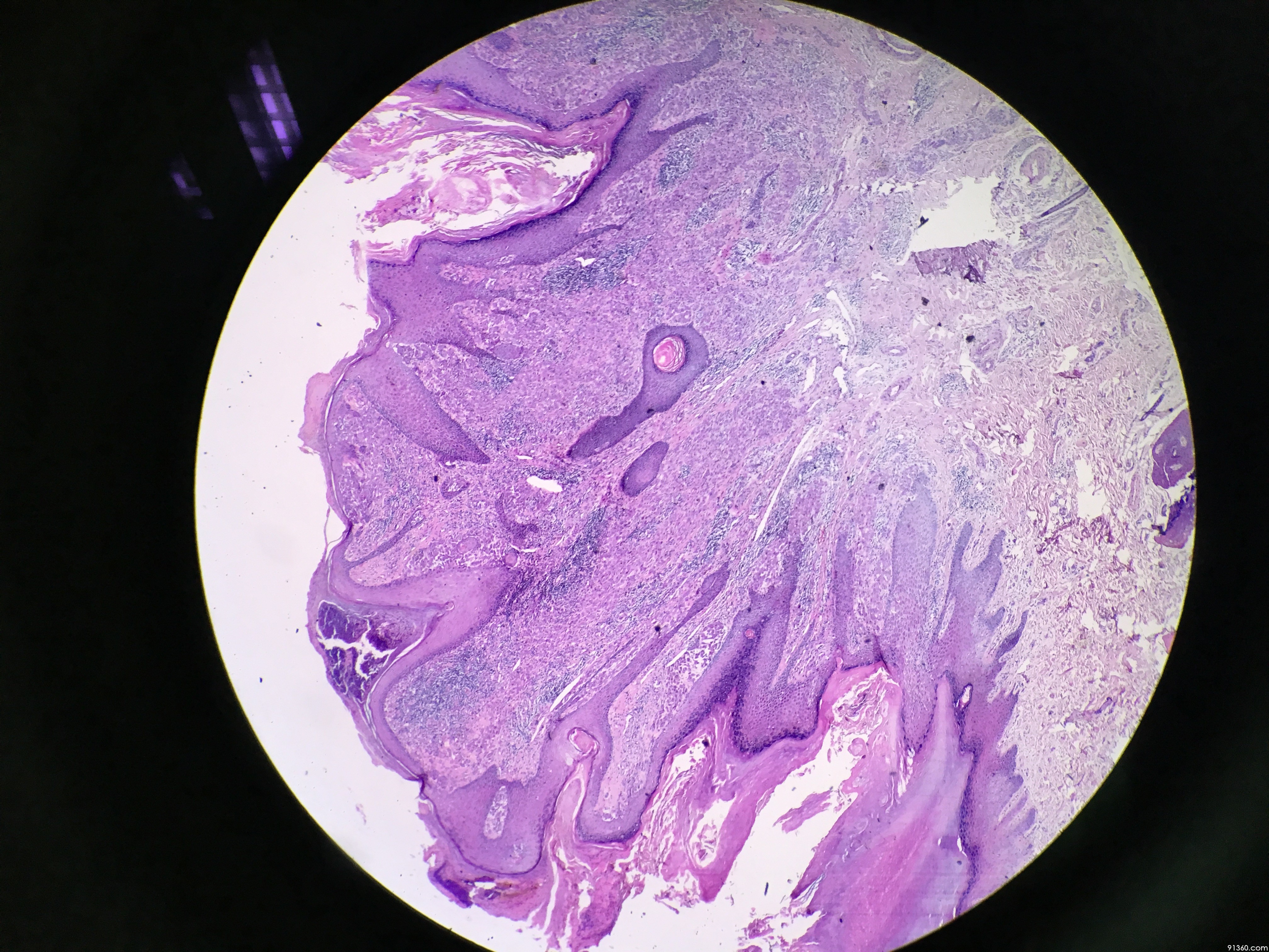 皮肤肿块 - 皮肤病理 - 91360病理论坛