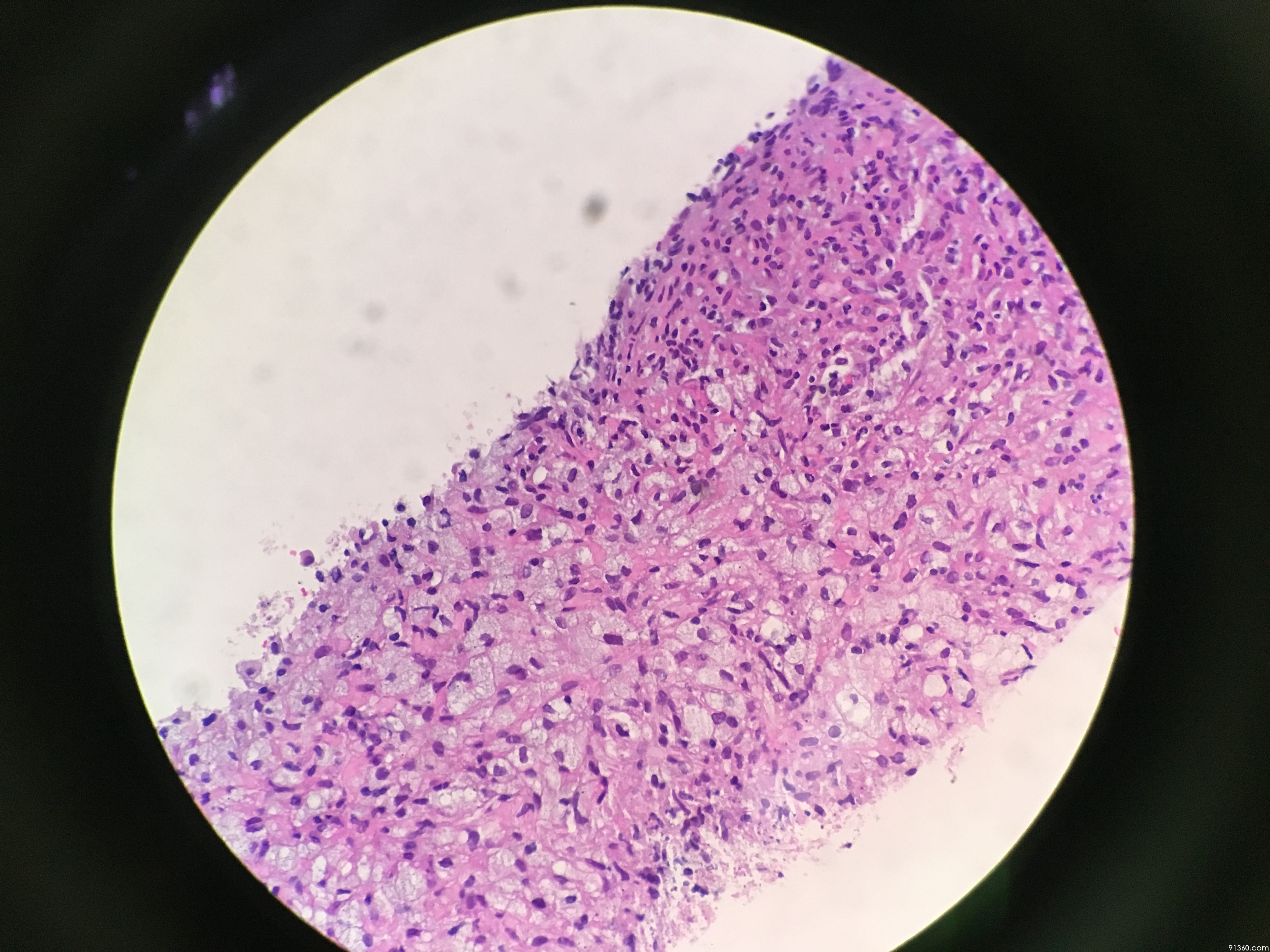 肺占位穿刺活检