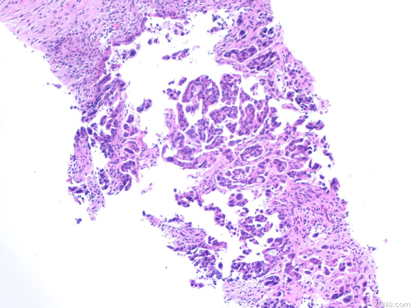 乳腺疾病118-25：乳腺浸润性导管癌伴腋窝淋巴结转移