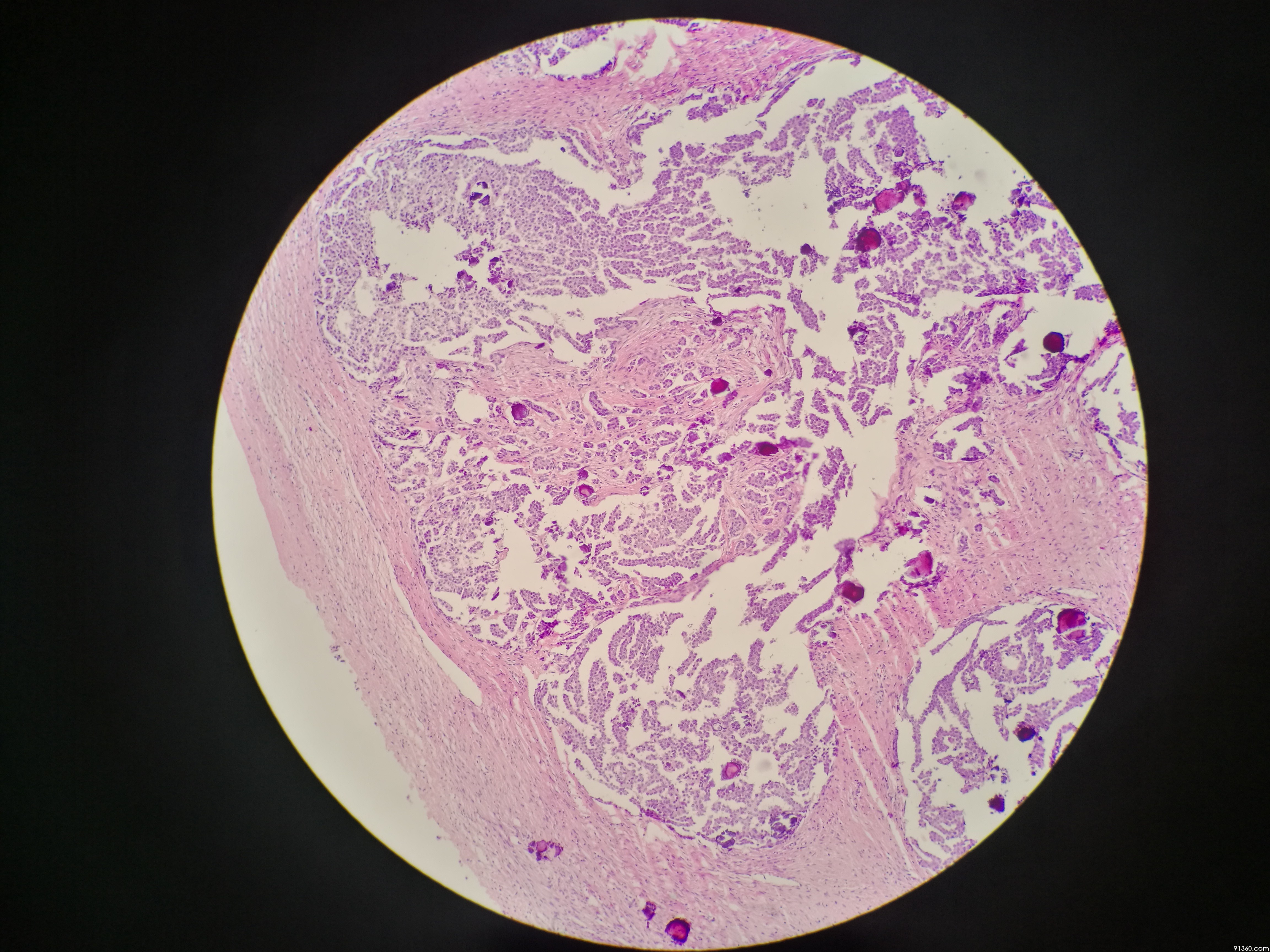 卵巢包块 考虑低级别浆液性癌讨论病例【中美加卵巢肿瘤病理交流群258