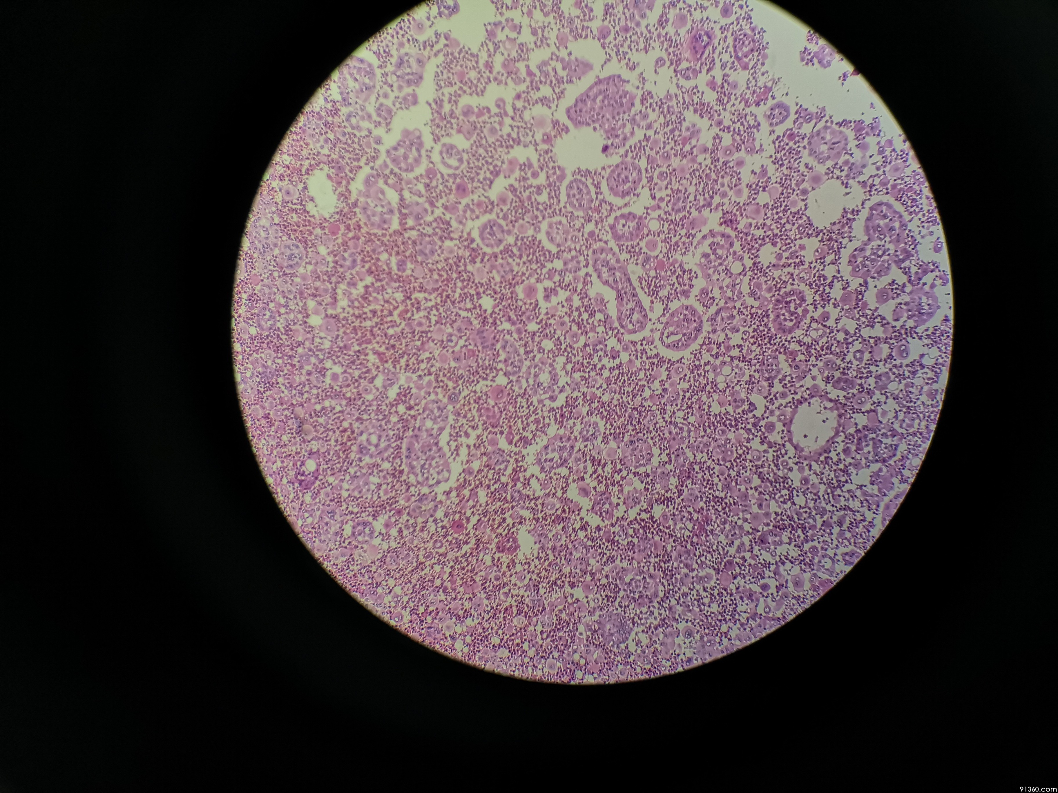 胸水间皮细胞图片