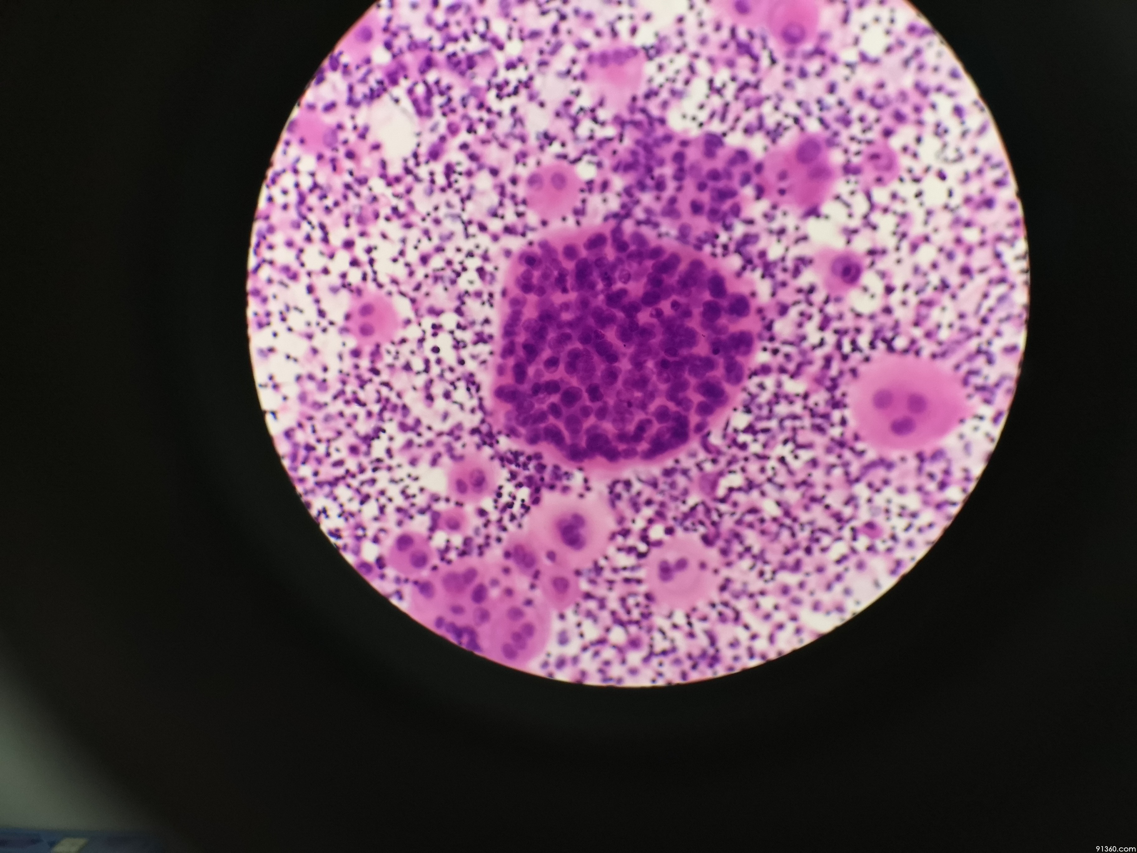 胸水间皮细胞图片