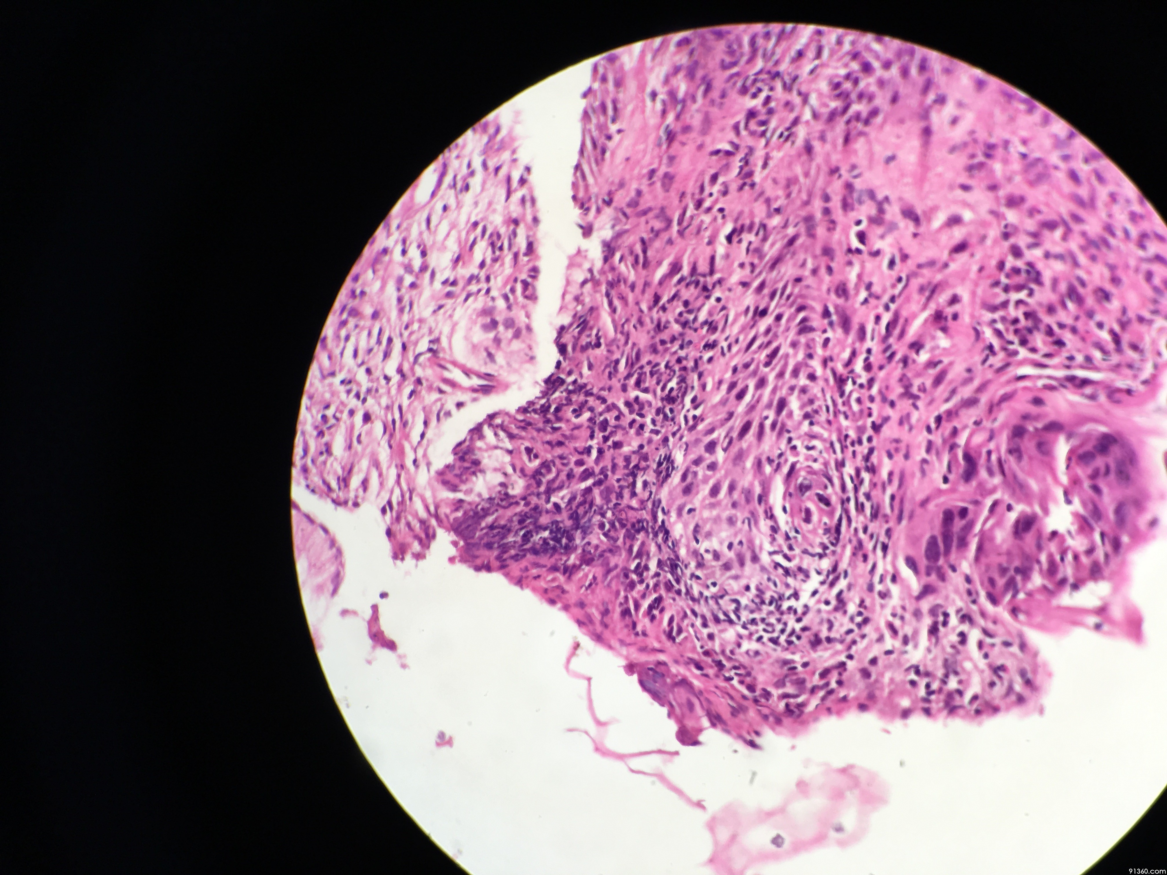 hsil中美加宫颈病理交流群病例779