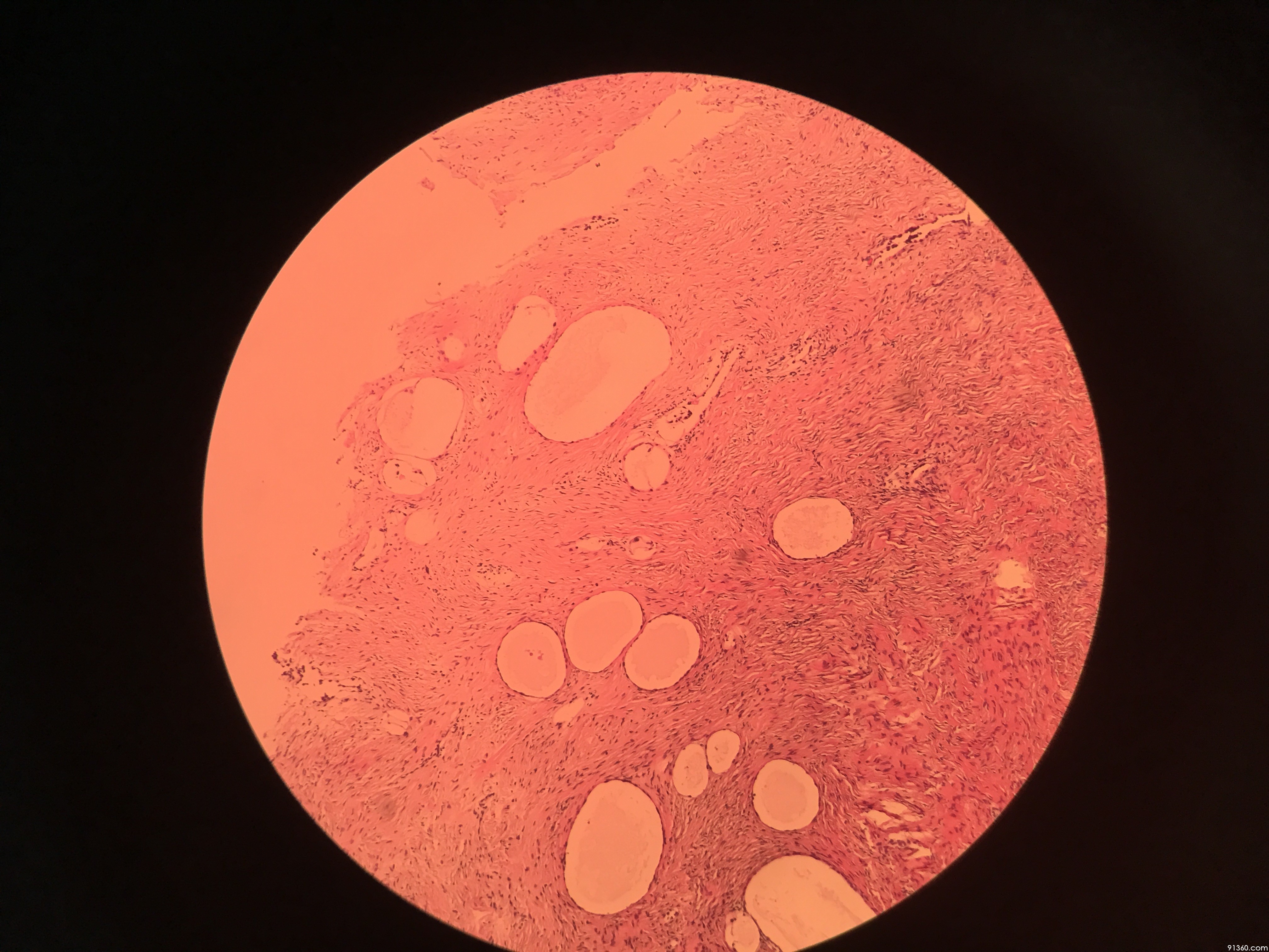 卵巢肿物 交界性透明细胞肿瘤?