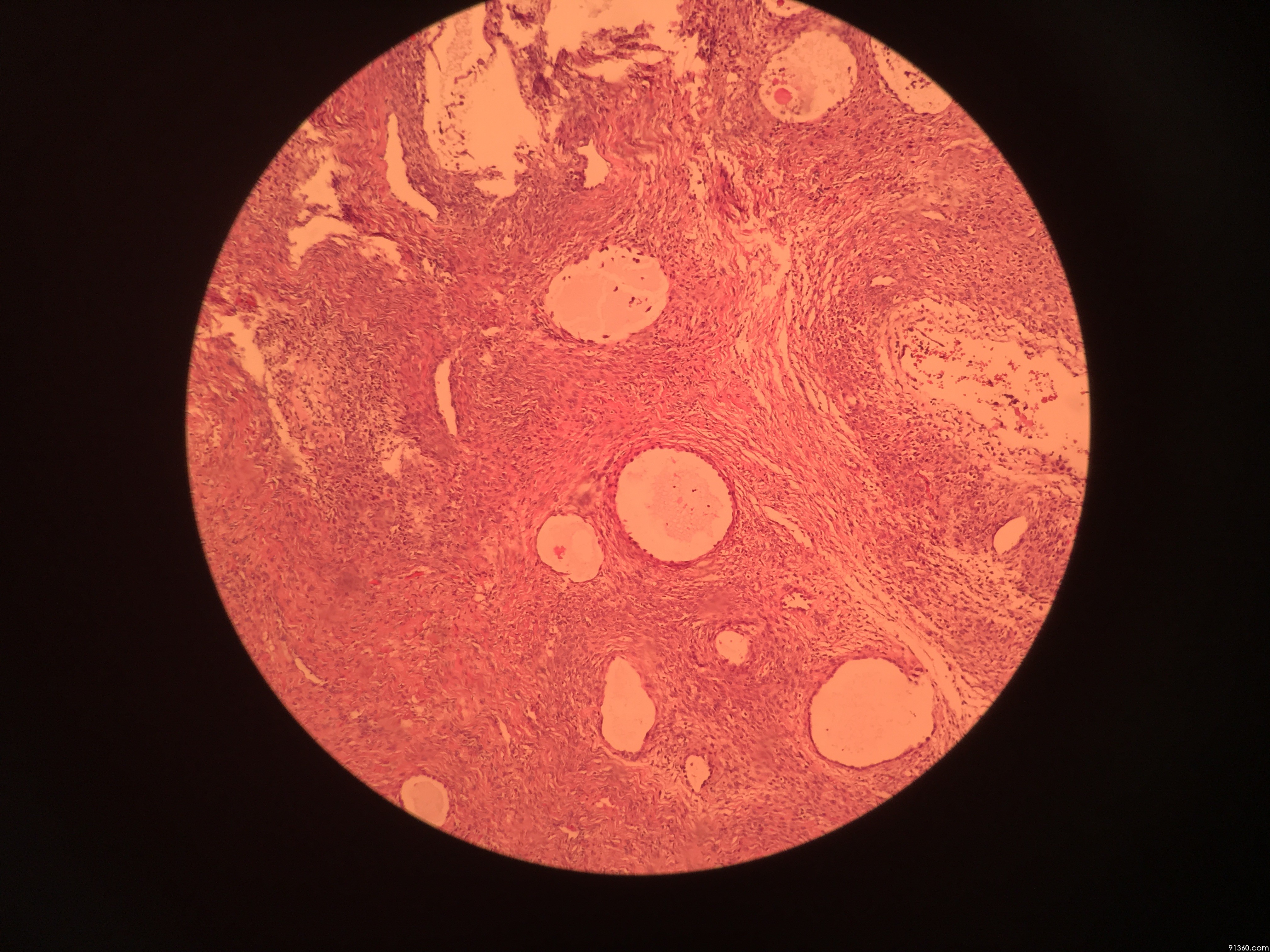 卵巢肿物 交界性透明细胞肿瘤?