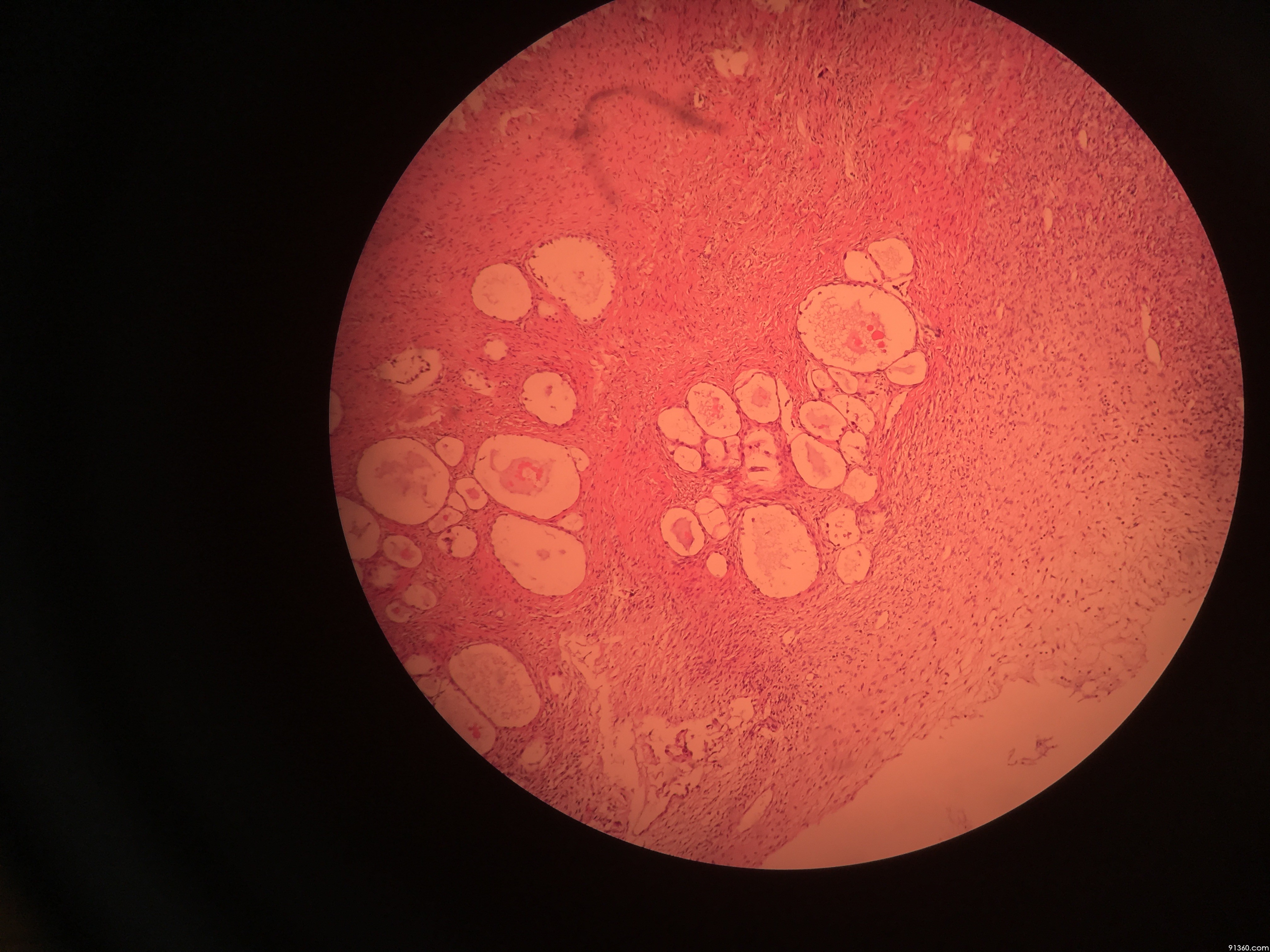 卵巢肿物 交界性透明细胞肿瘤?