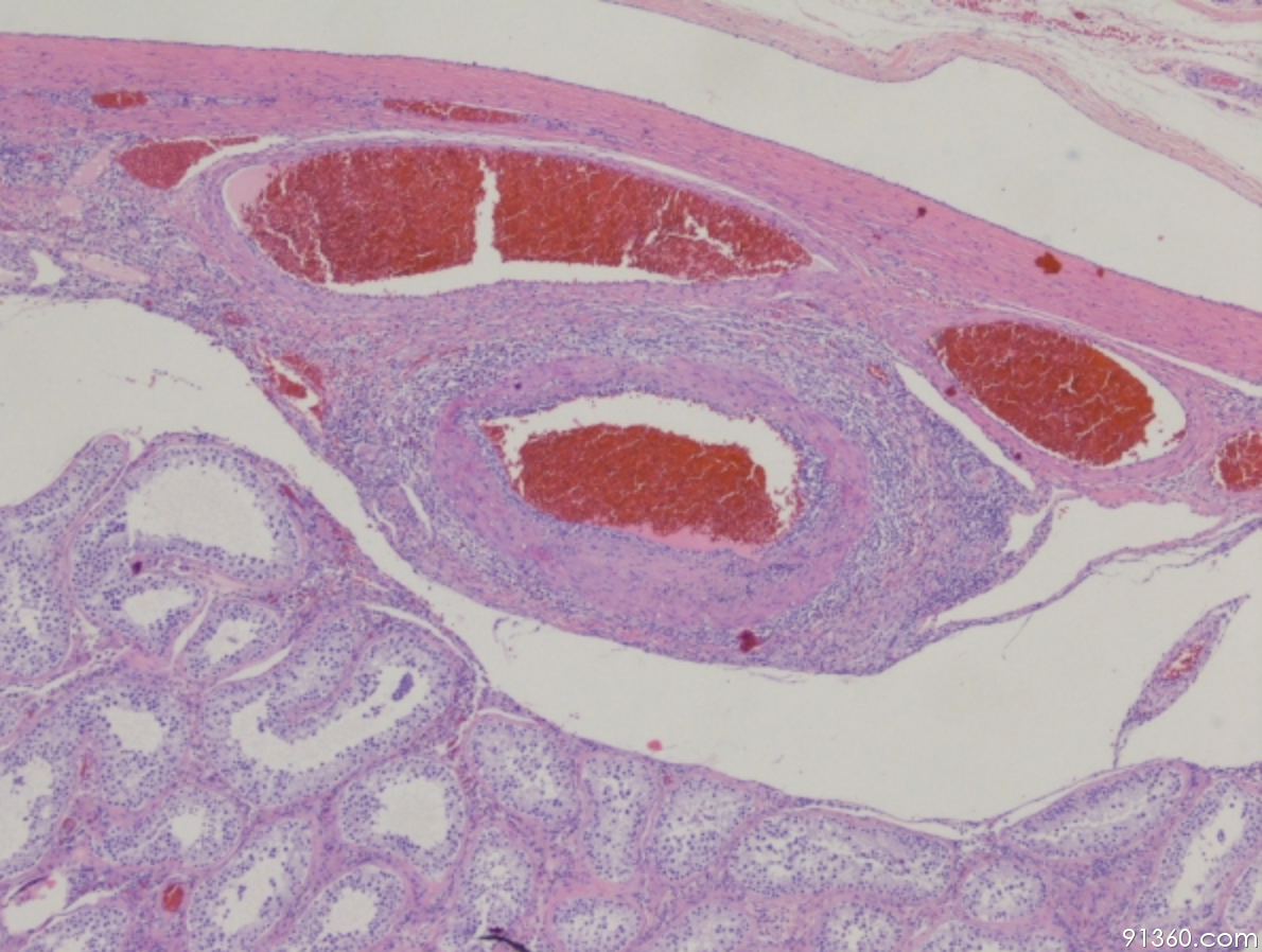 睾丸小管内精原细胞瘤