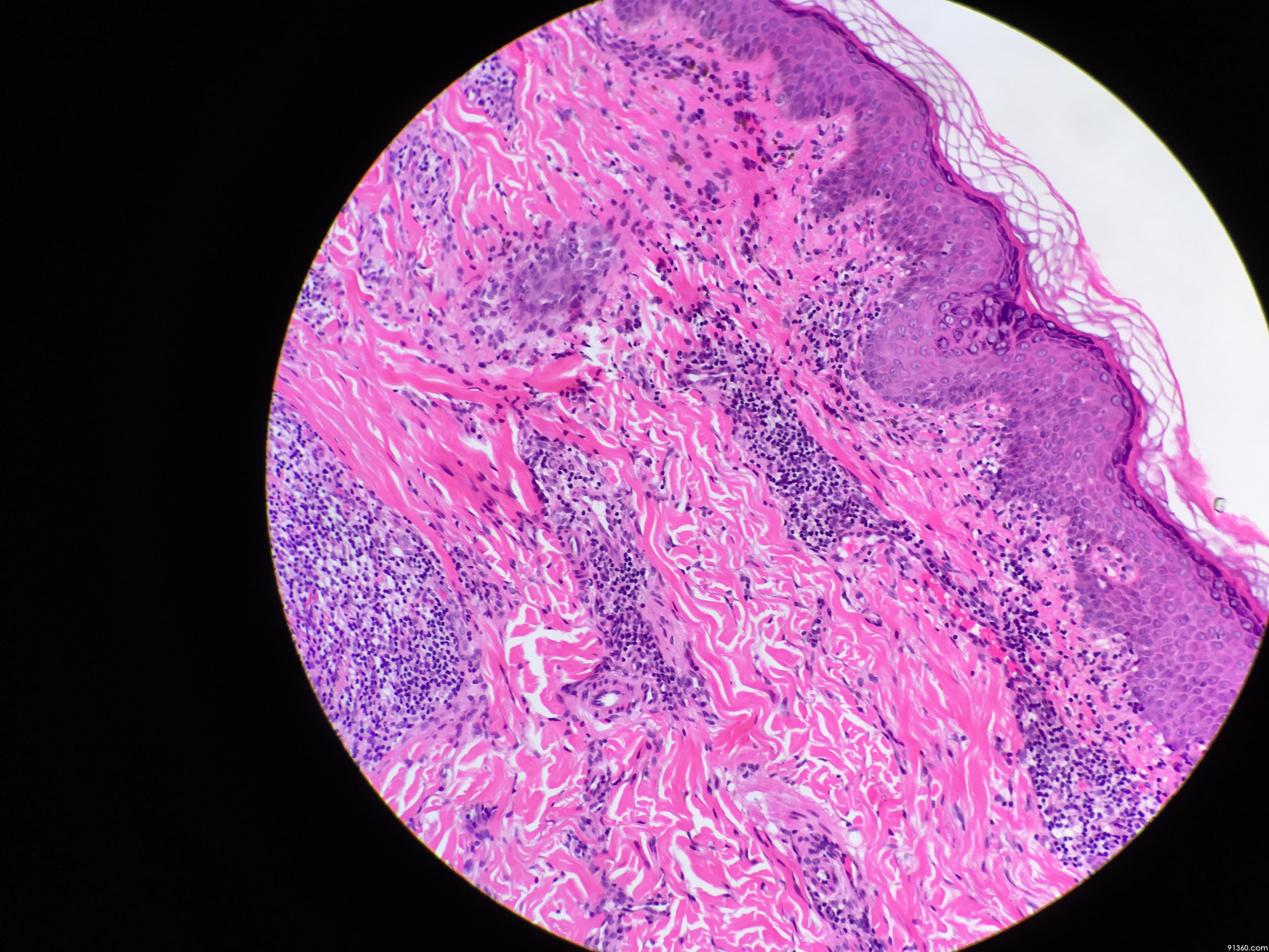 面部皮肤斑块 - 皮肤病理 - 91360病理论坛